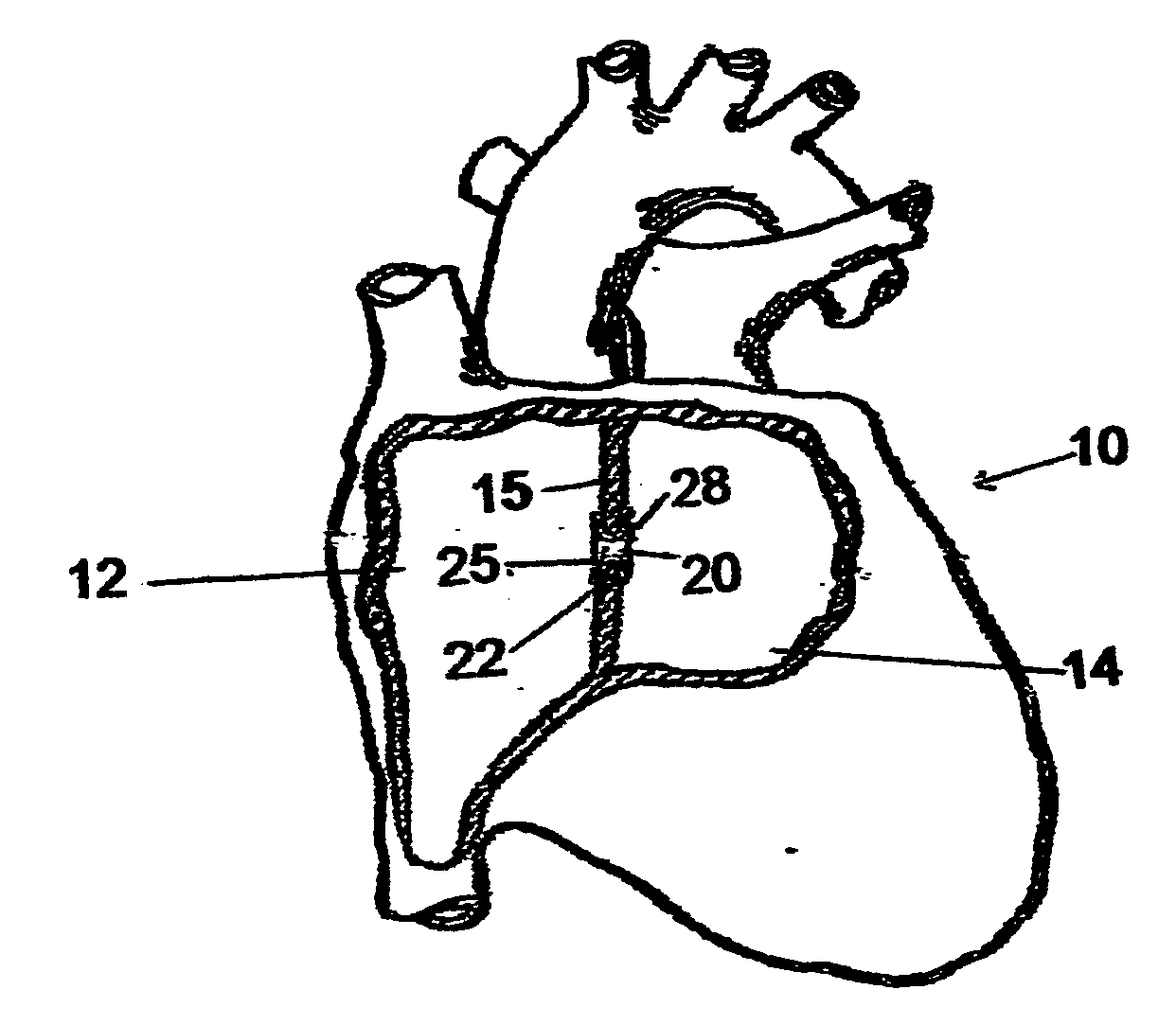 Implantable chamber for biological induction or enhancement of muscle contraction