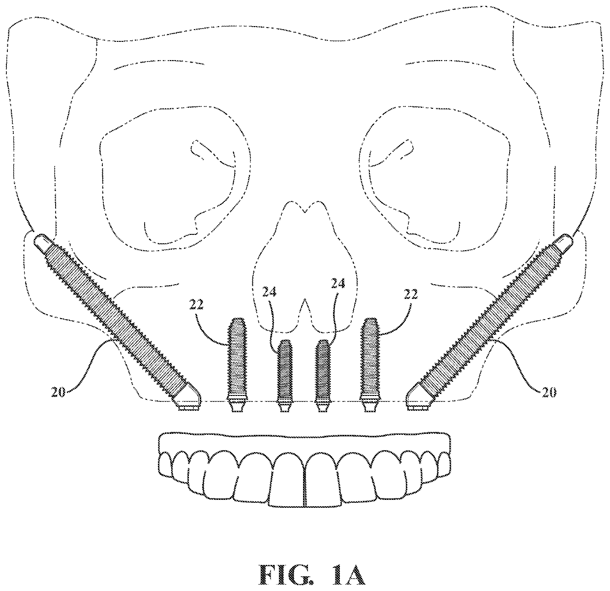 Autografting tool for deep reach applications