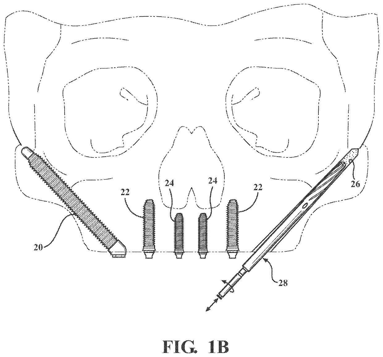 Autografting tool for deep reach applications