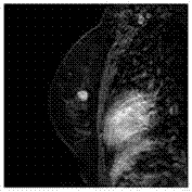 Method and device for judging whether breast mass is benign or malignant