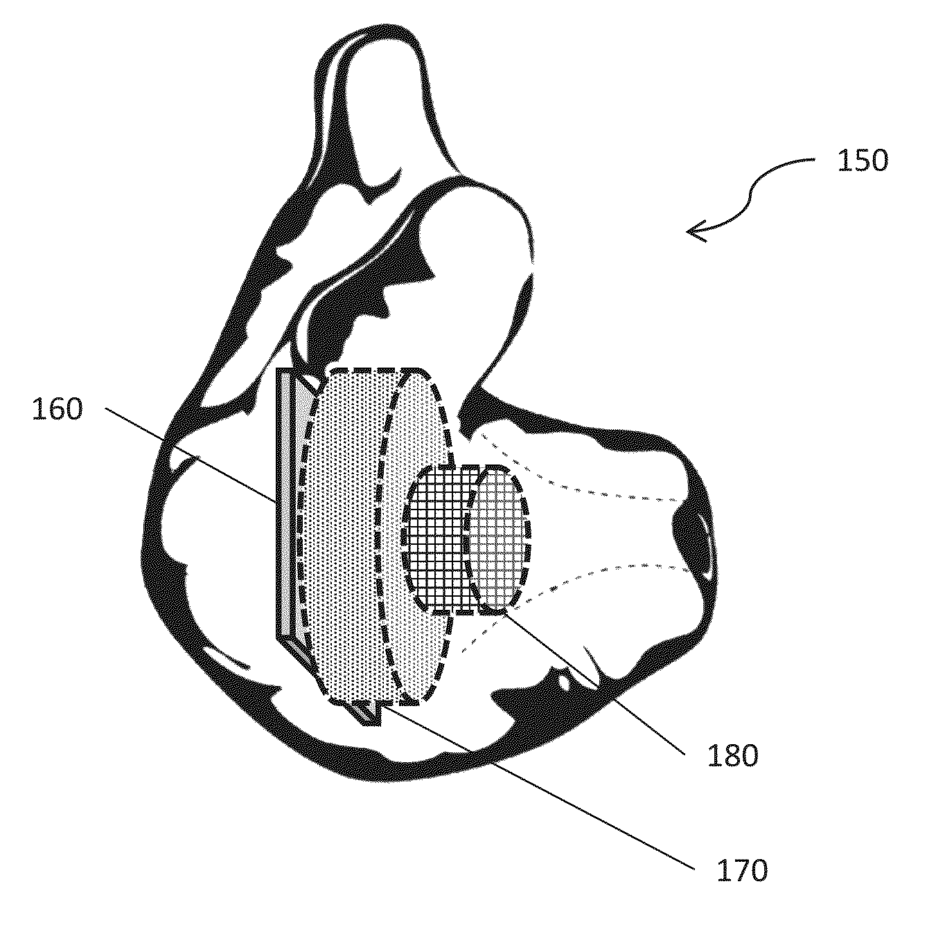 Sound system with ear device with improved fit and sound