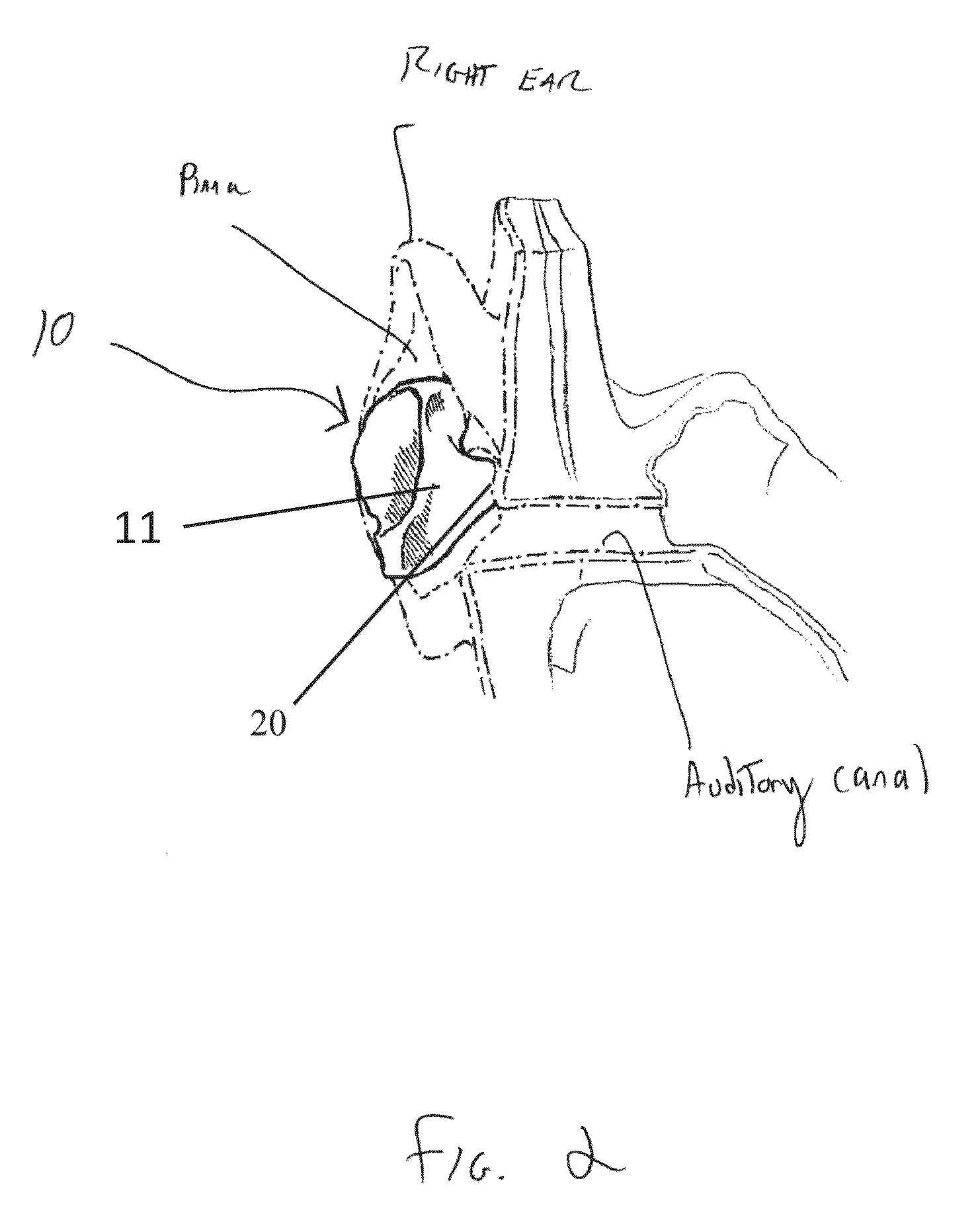 Sound system with ear device with improved fit and sound