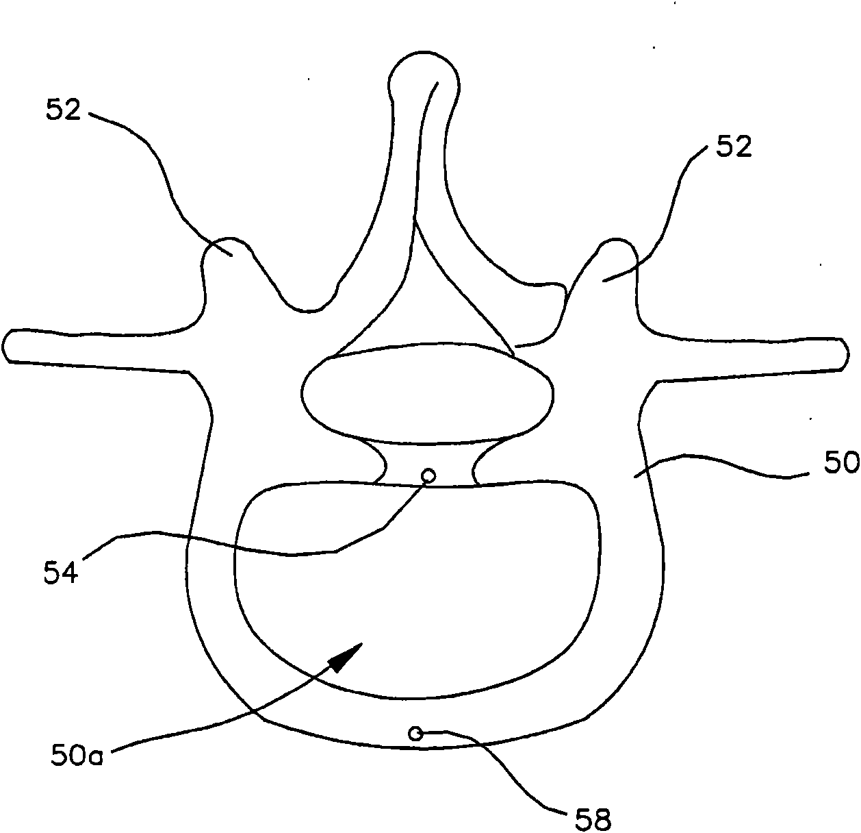 Multi-lobe artificial spine joint