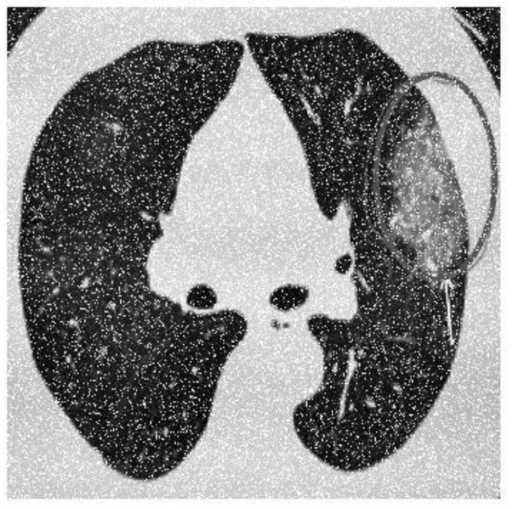 CT image denoising method based on self-adaptive median filtering