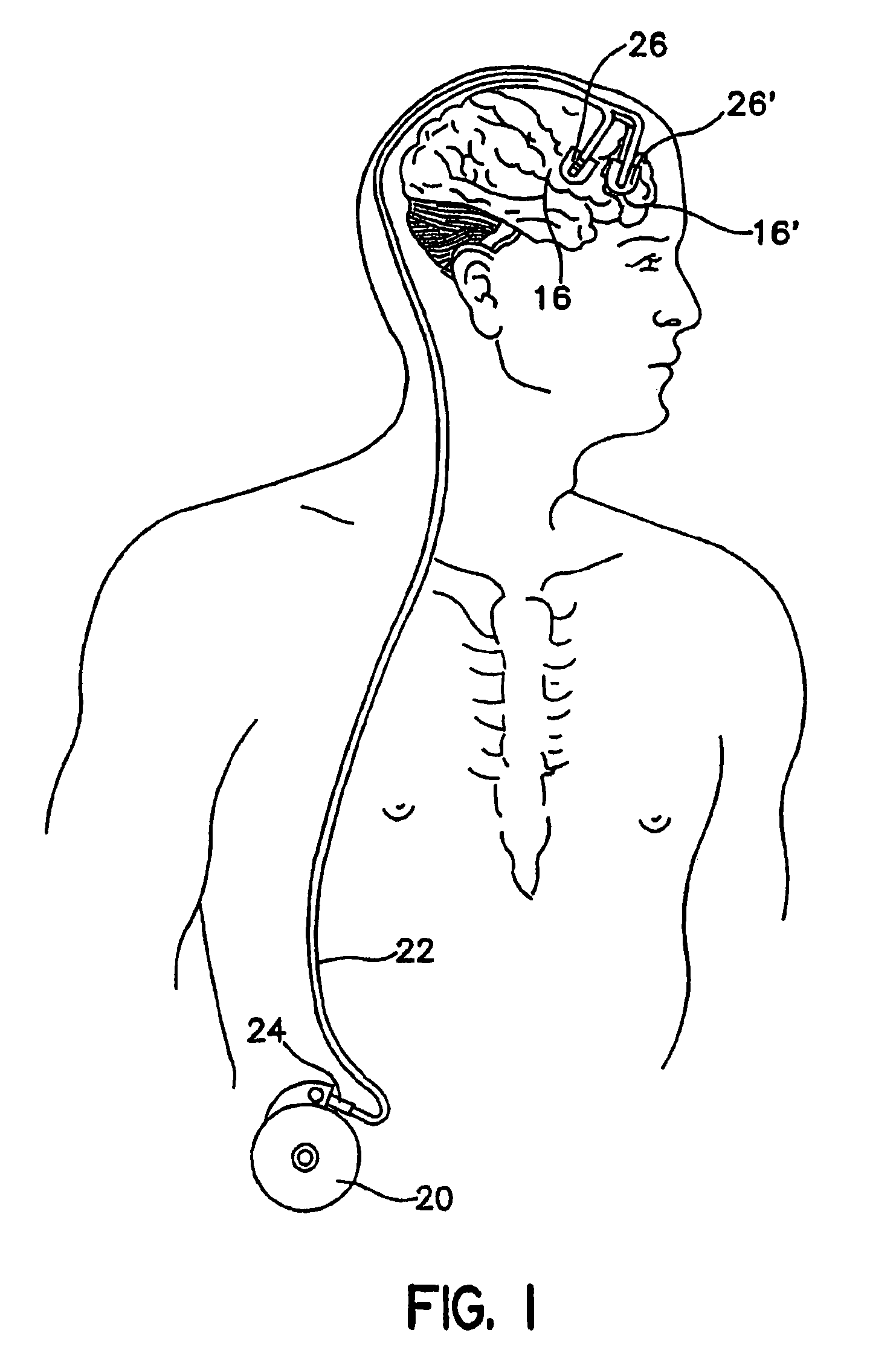 Catheter for target specific drug delivery