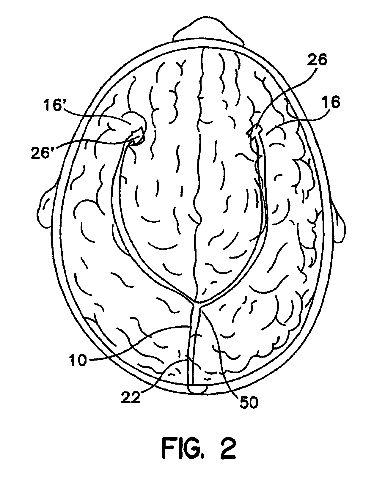 Catheter for target specific drug delivery