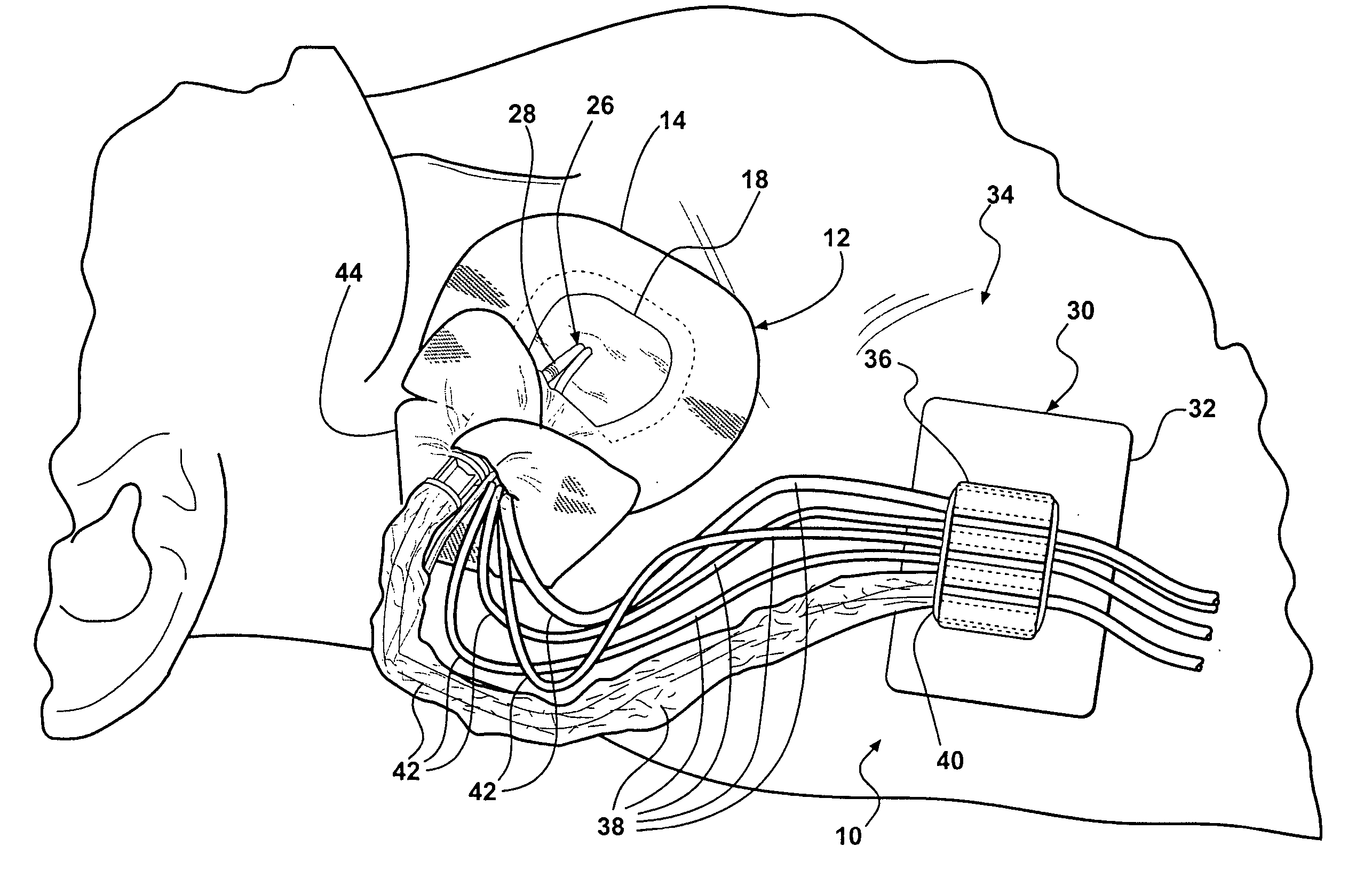 Jugular and subclavian access site dressing, anchoring system and method