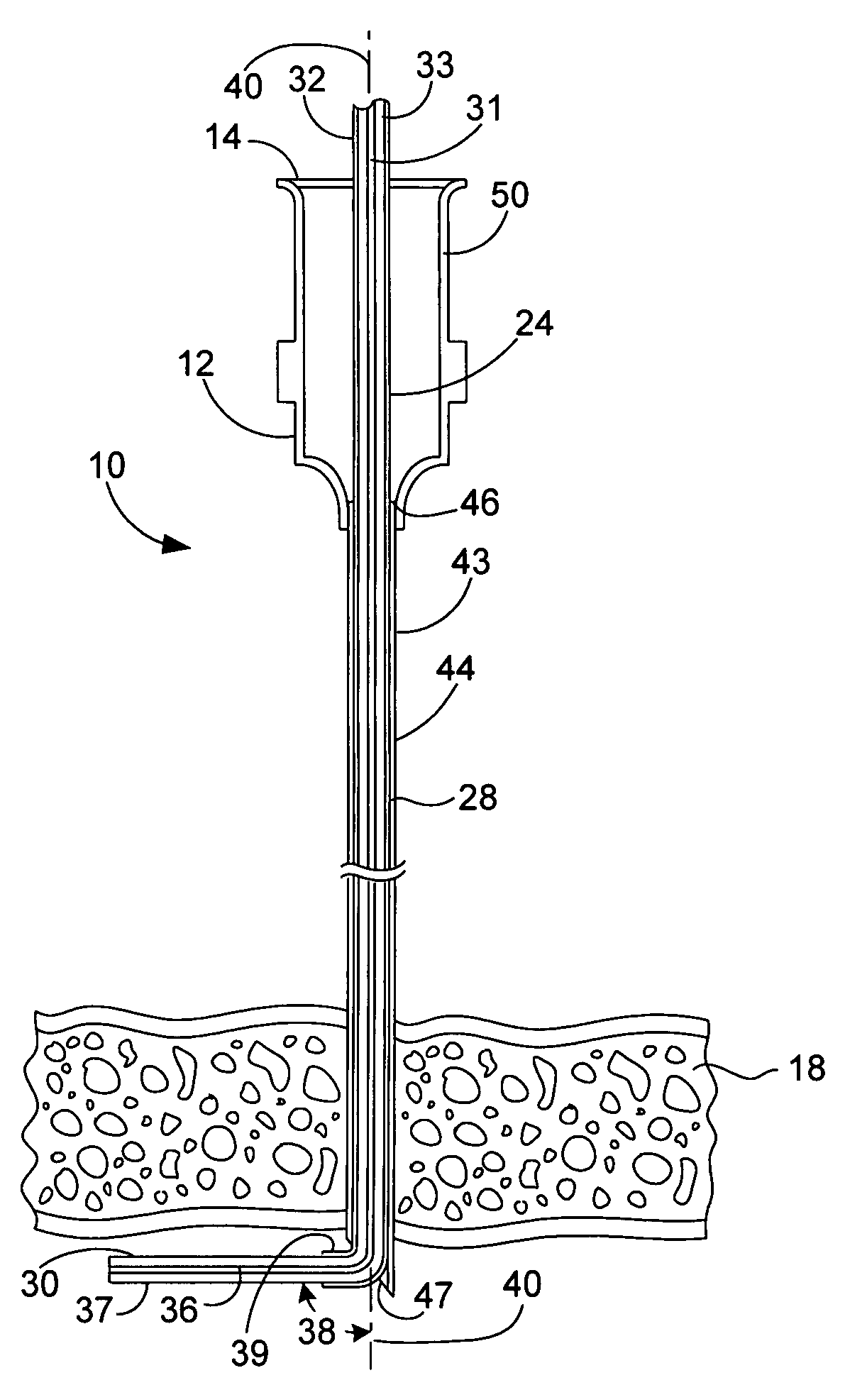 Surgical microwave ablation assembly