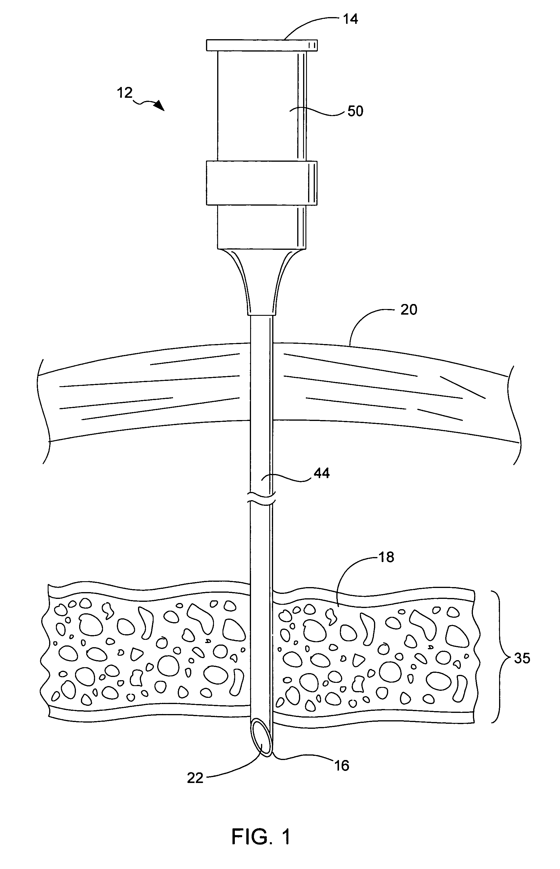 Surgical microwave ablation assembly