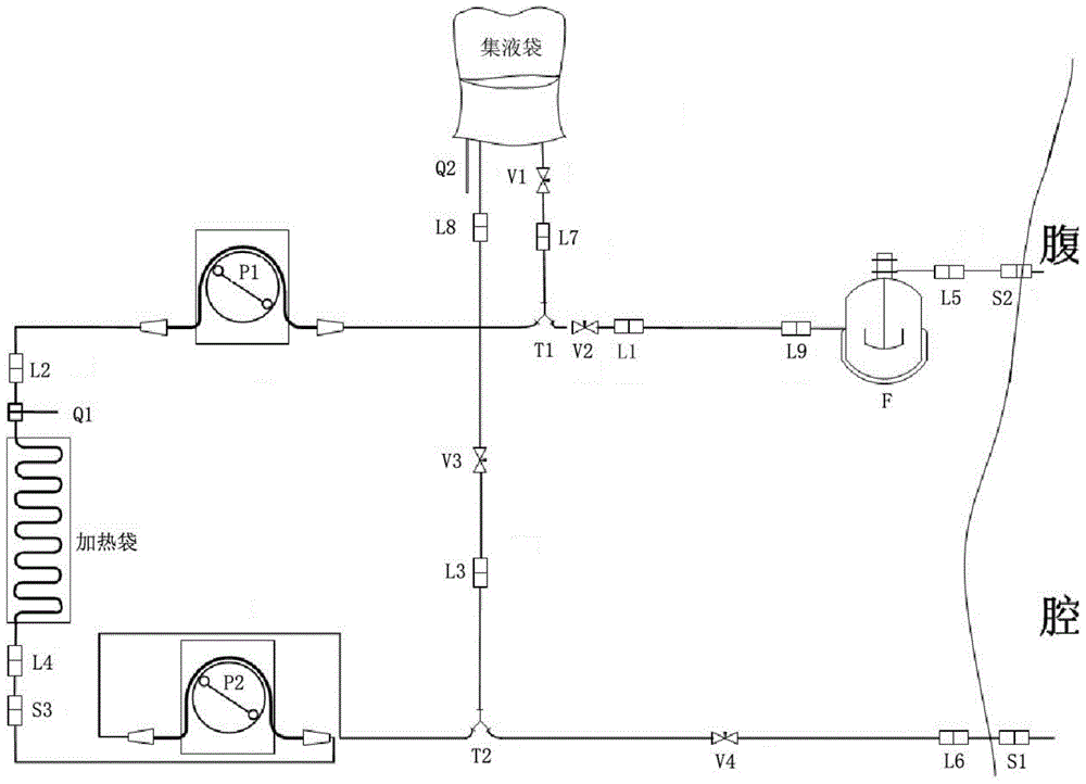 Intraperitoneal hyperthermic chemotherapy circulation circuit device