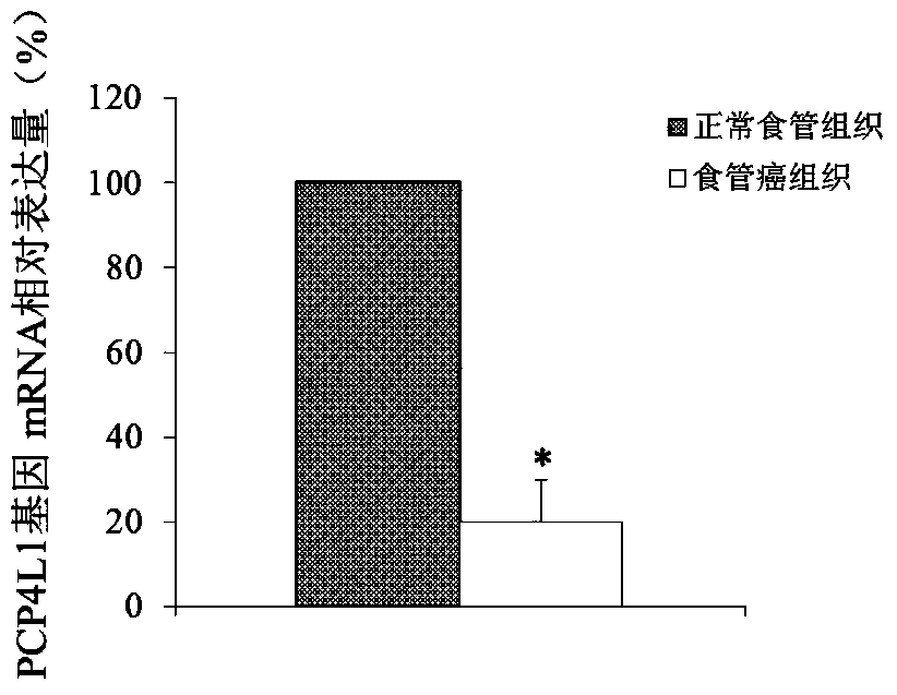 Esophageal cancer markers