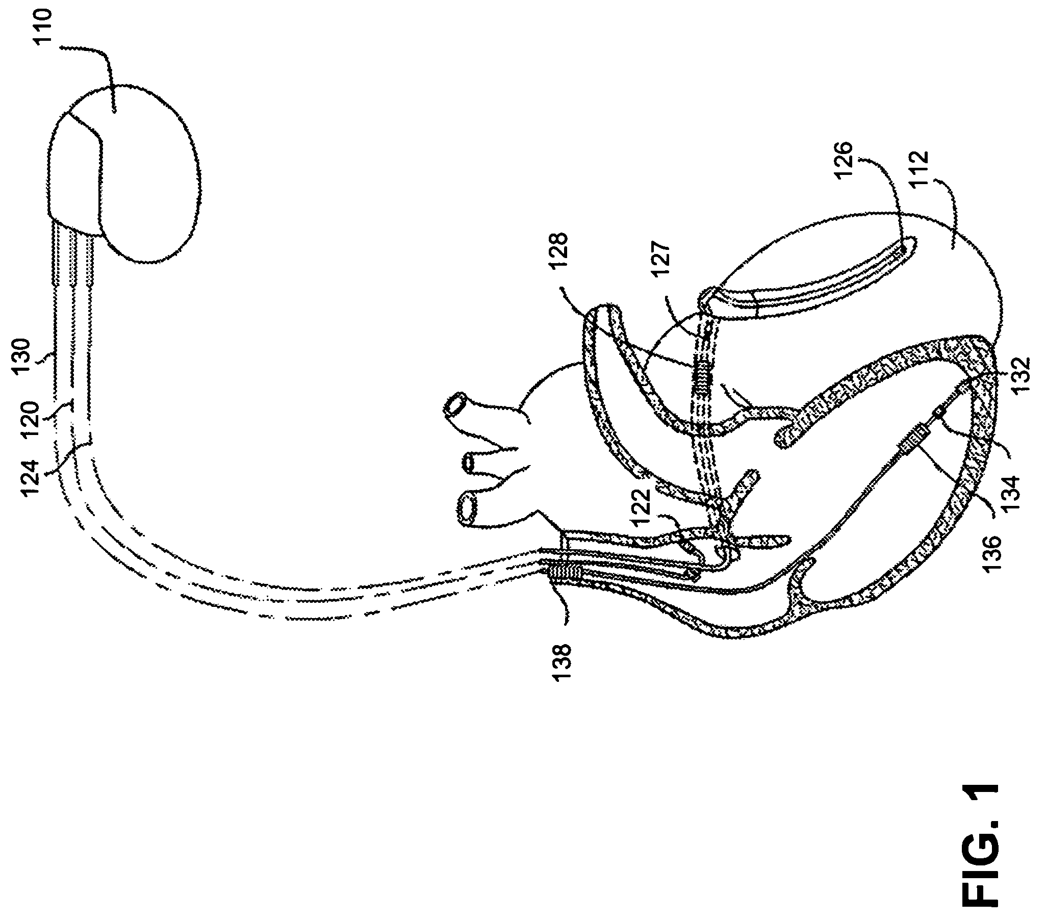 Complimentary activity sensor network for disease monitoring and therapy modulation in an implantable device