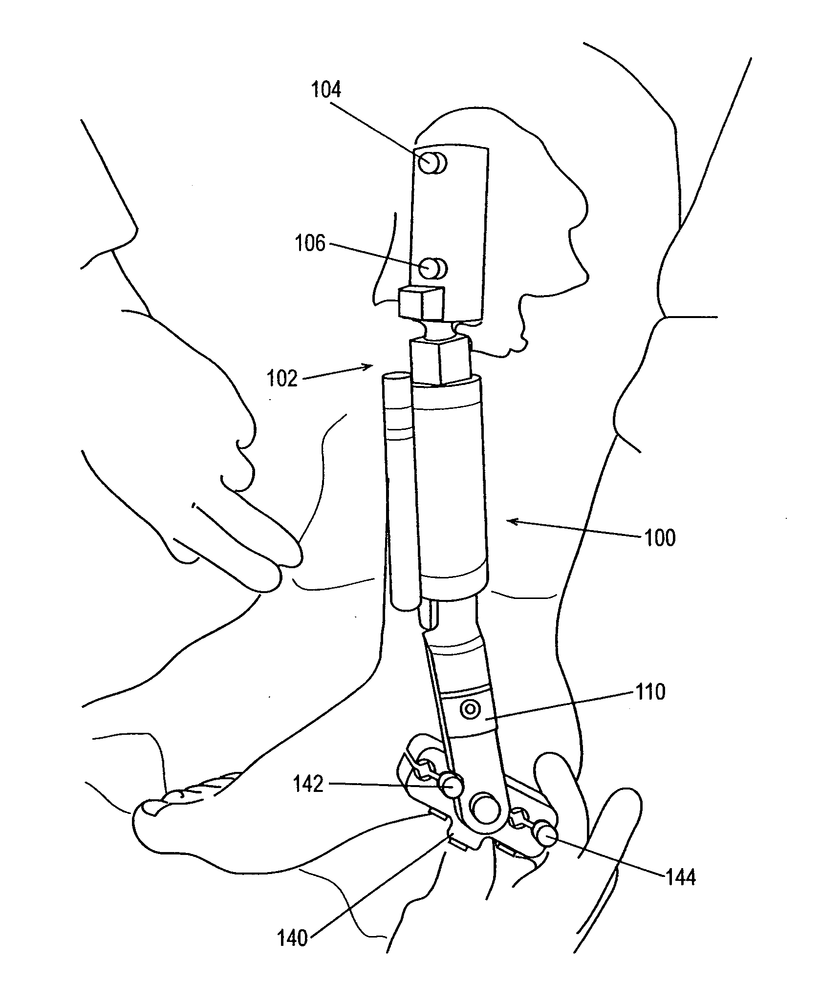 External fixation apparatus and method