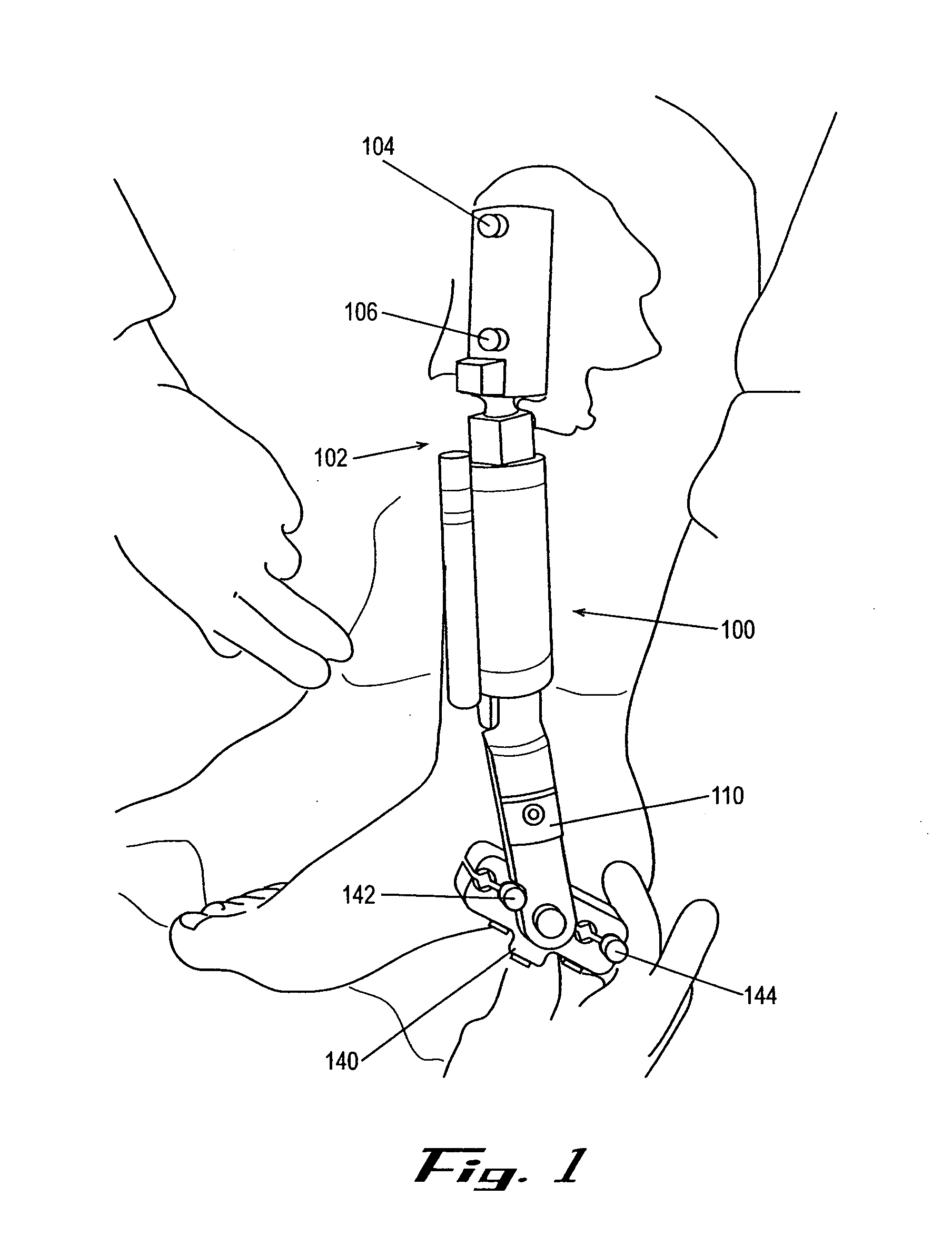 External fixation apparatus and method