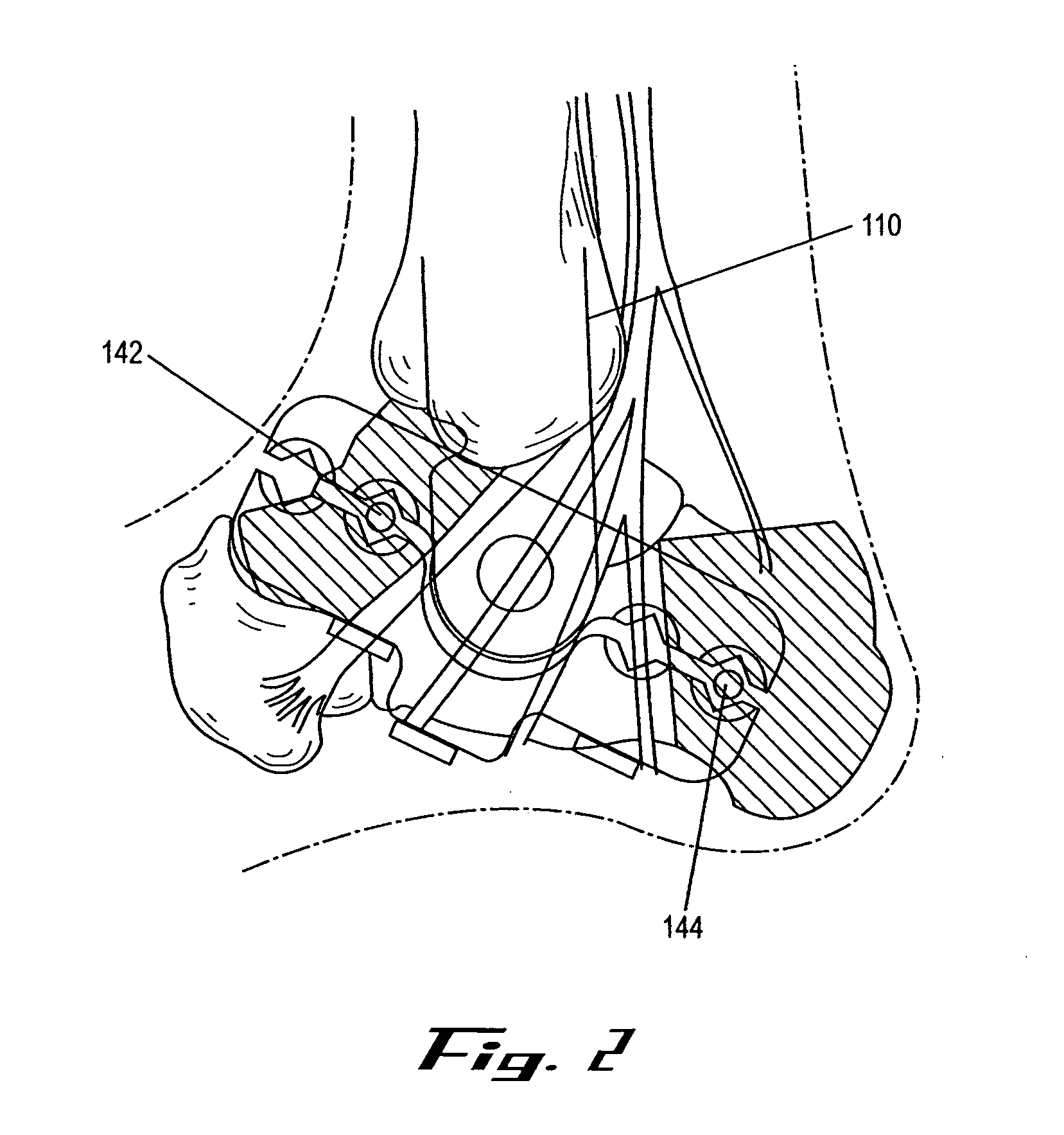 External fixation apparatus and method