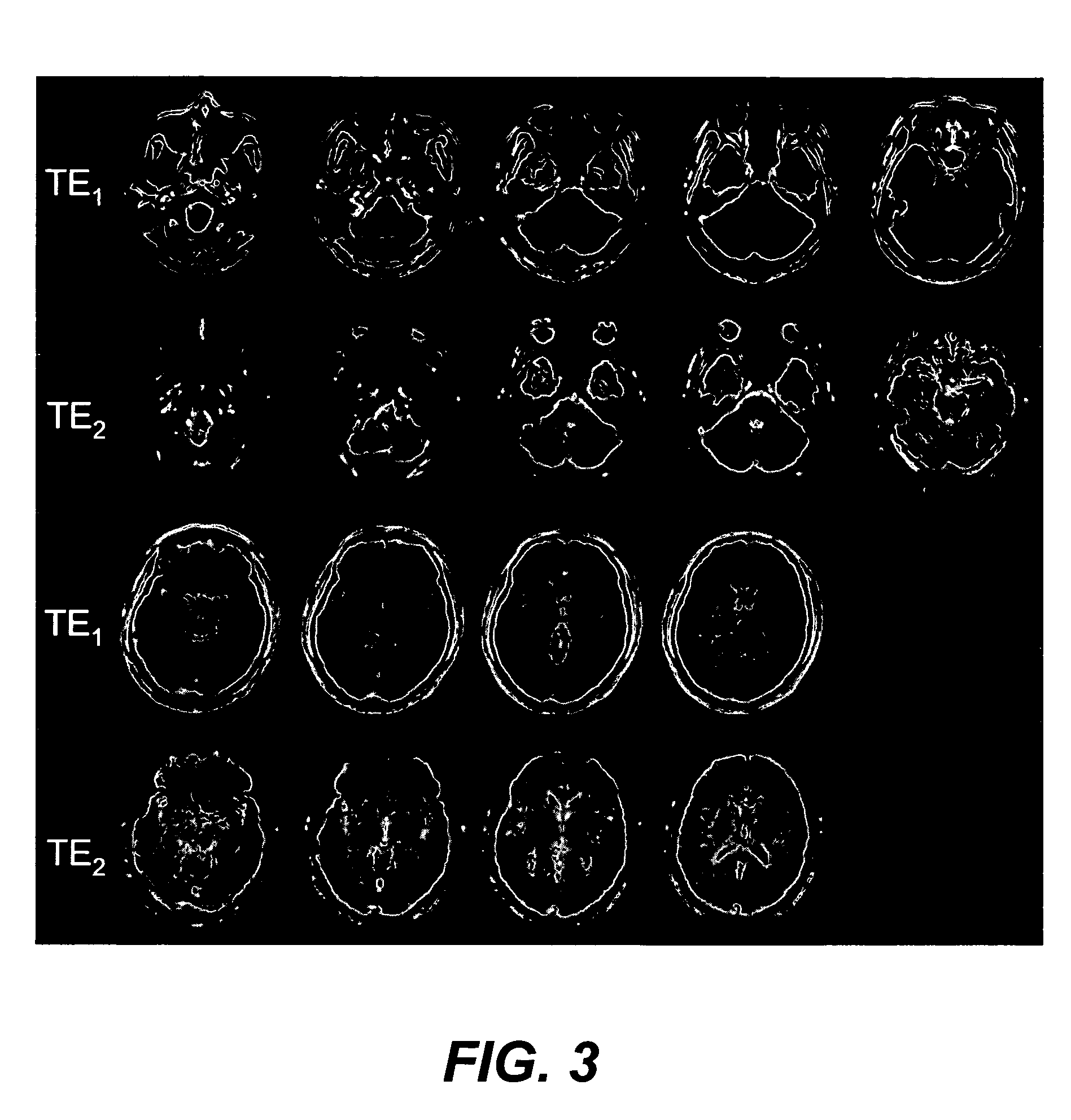 Dual gradient echo pulse sequence using interleaved spiral-out spiral-in k-space trajectories