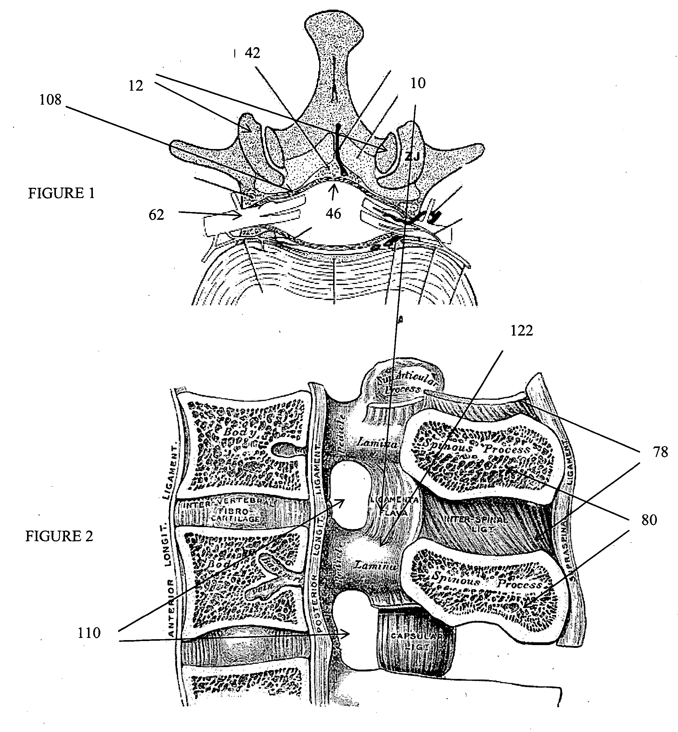 Devices and methods for tissue modification