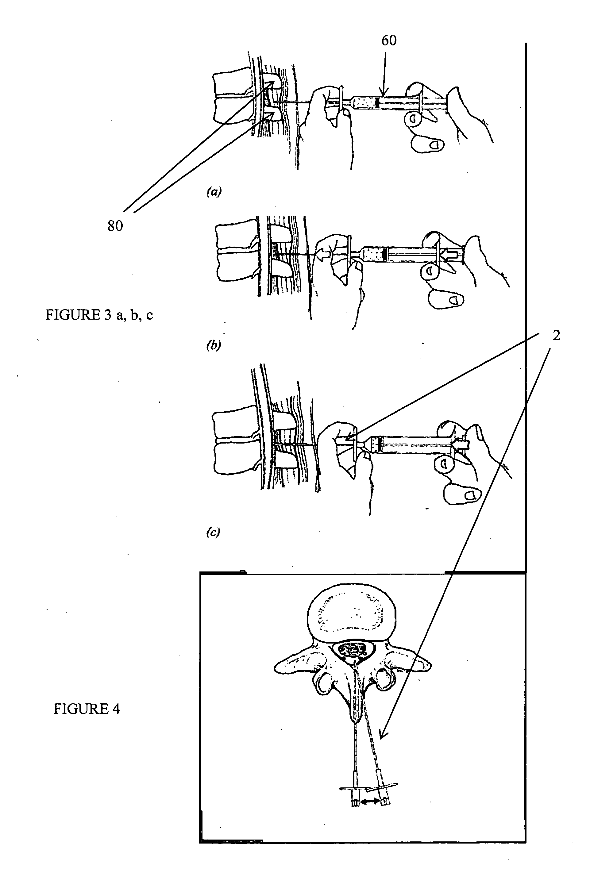 Devices and methods for tissue modification