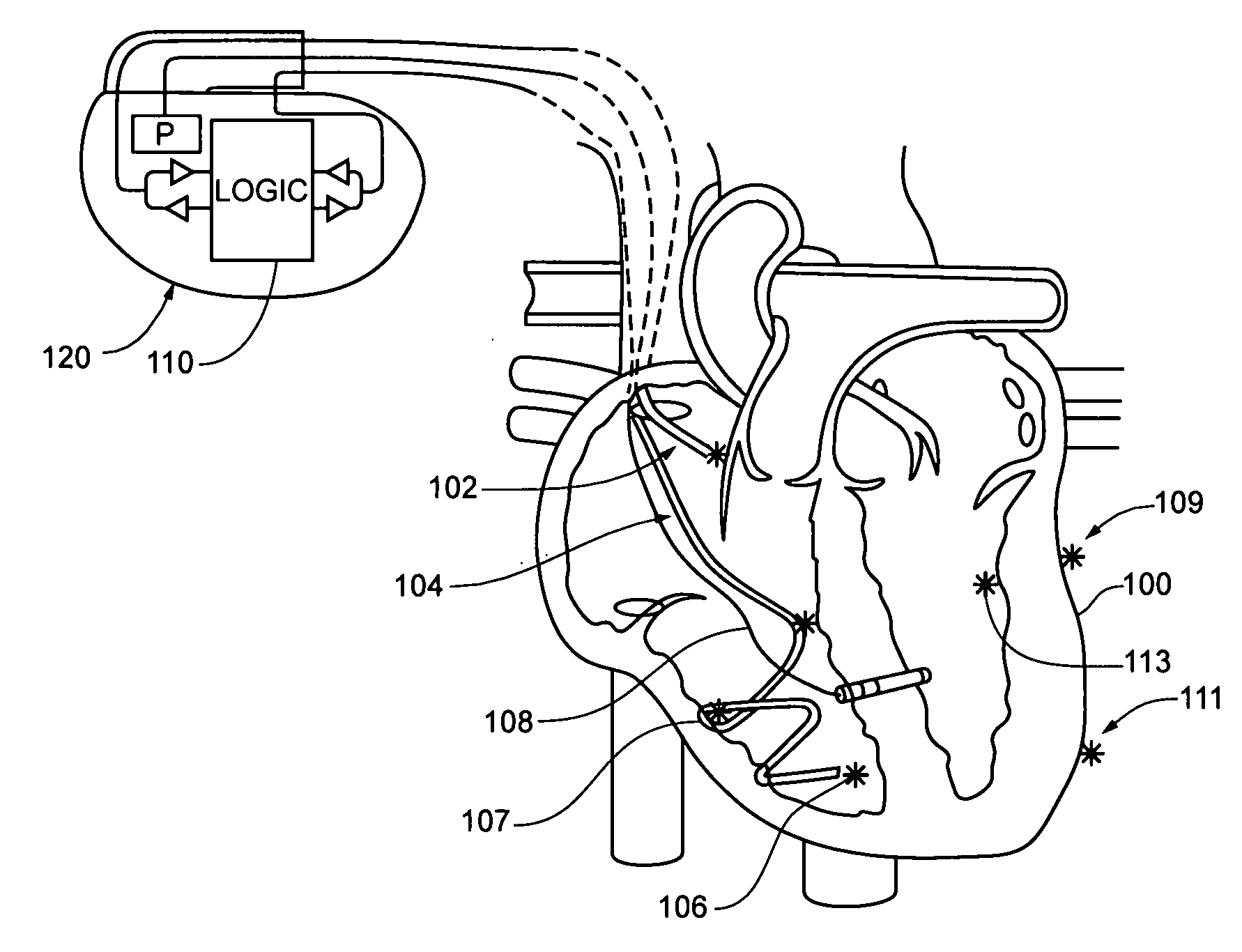 Cardiac stimulation apparatus and method for the control of hypertension