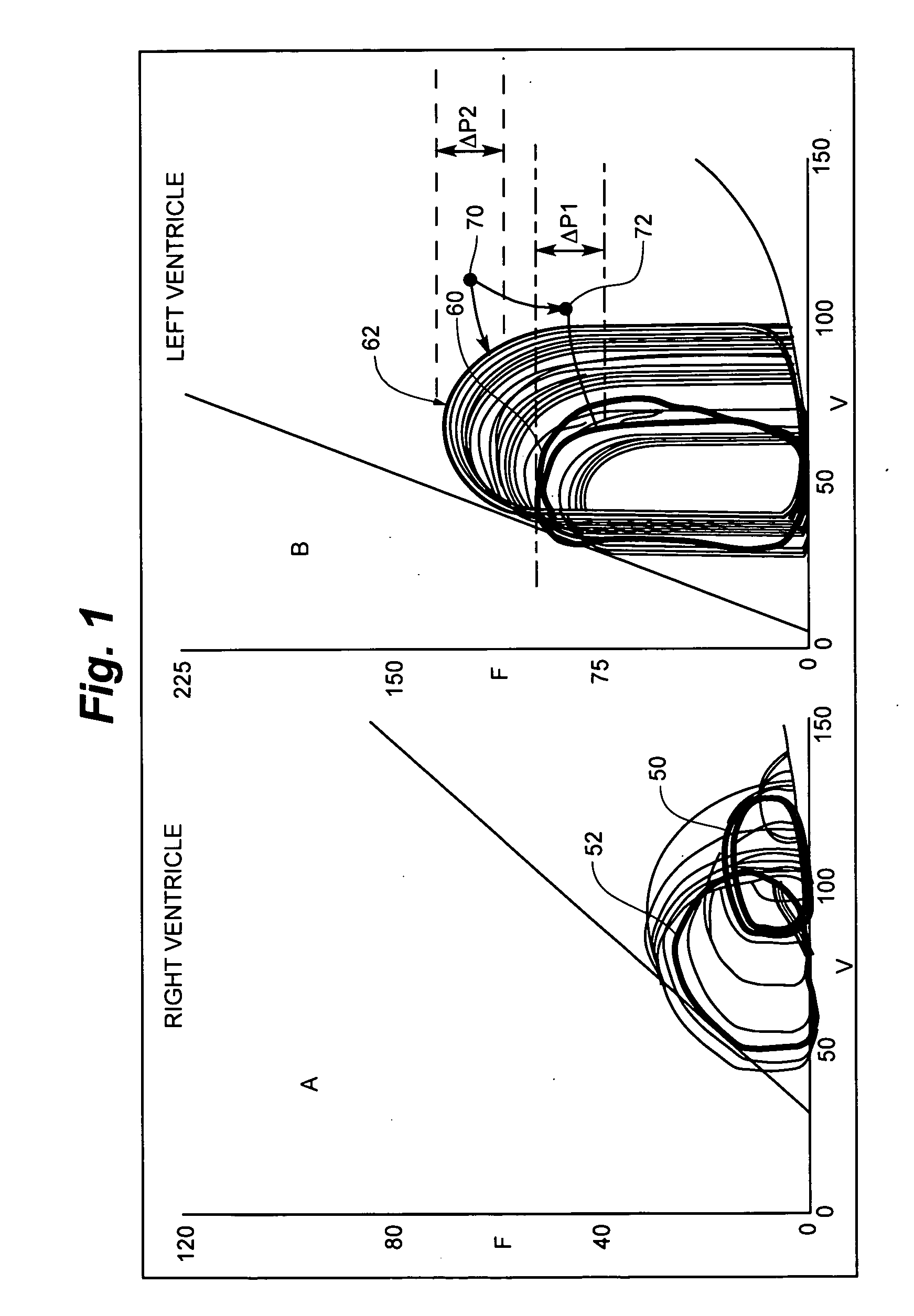 Cardiac stimulation apparatus and method for the control of hypertension