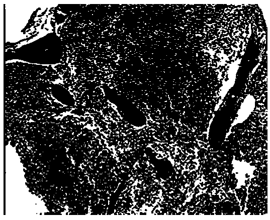 Bone marrow specimen processing method, decalcification solution, and applications