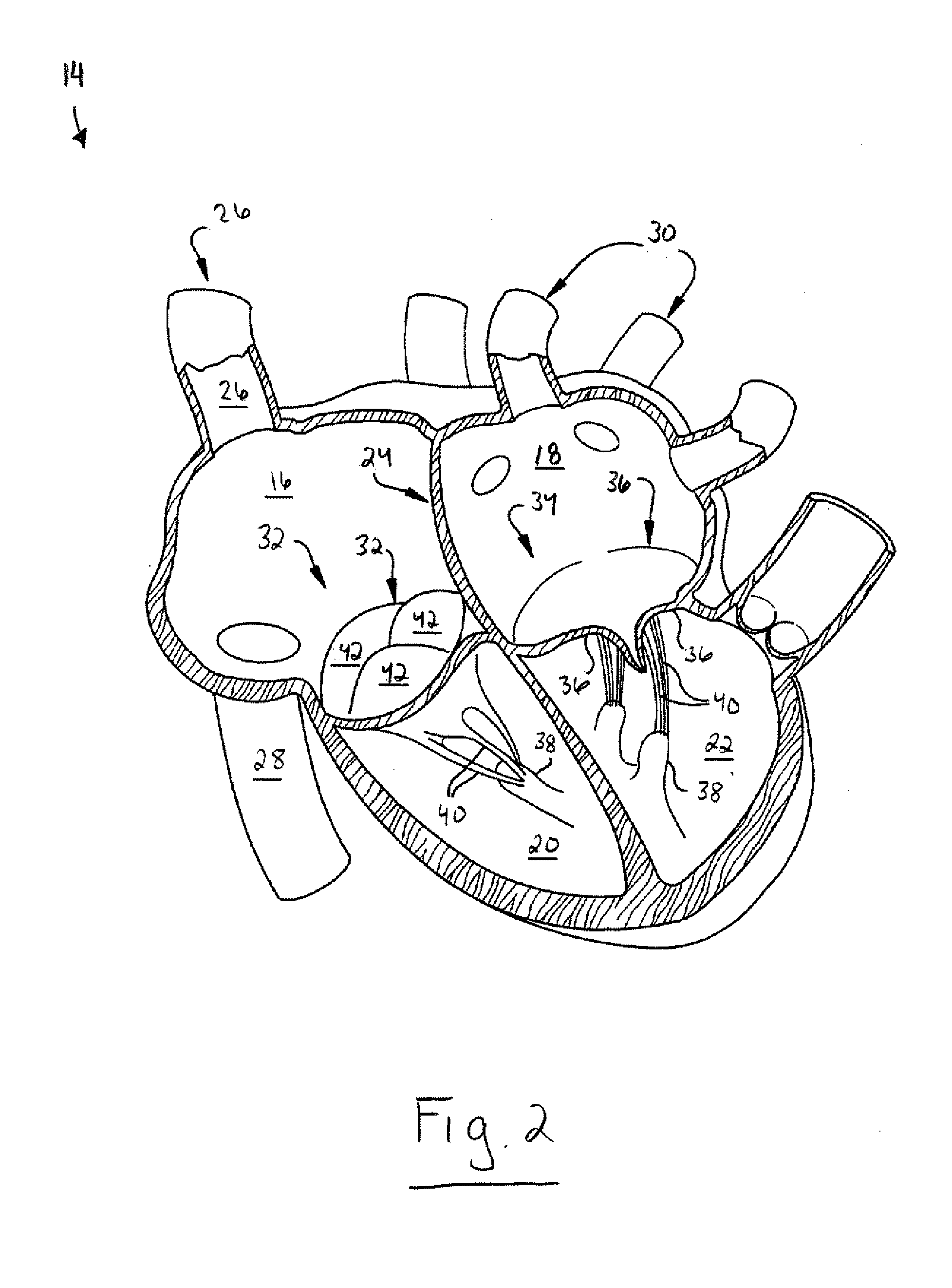 Apparatus, system, and method for treating a regurgitant heart valve