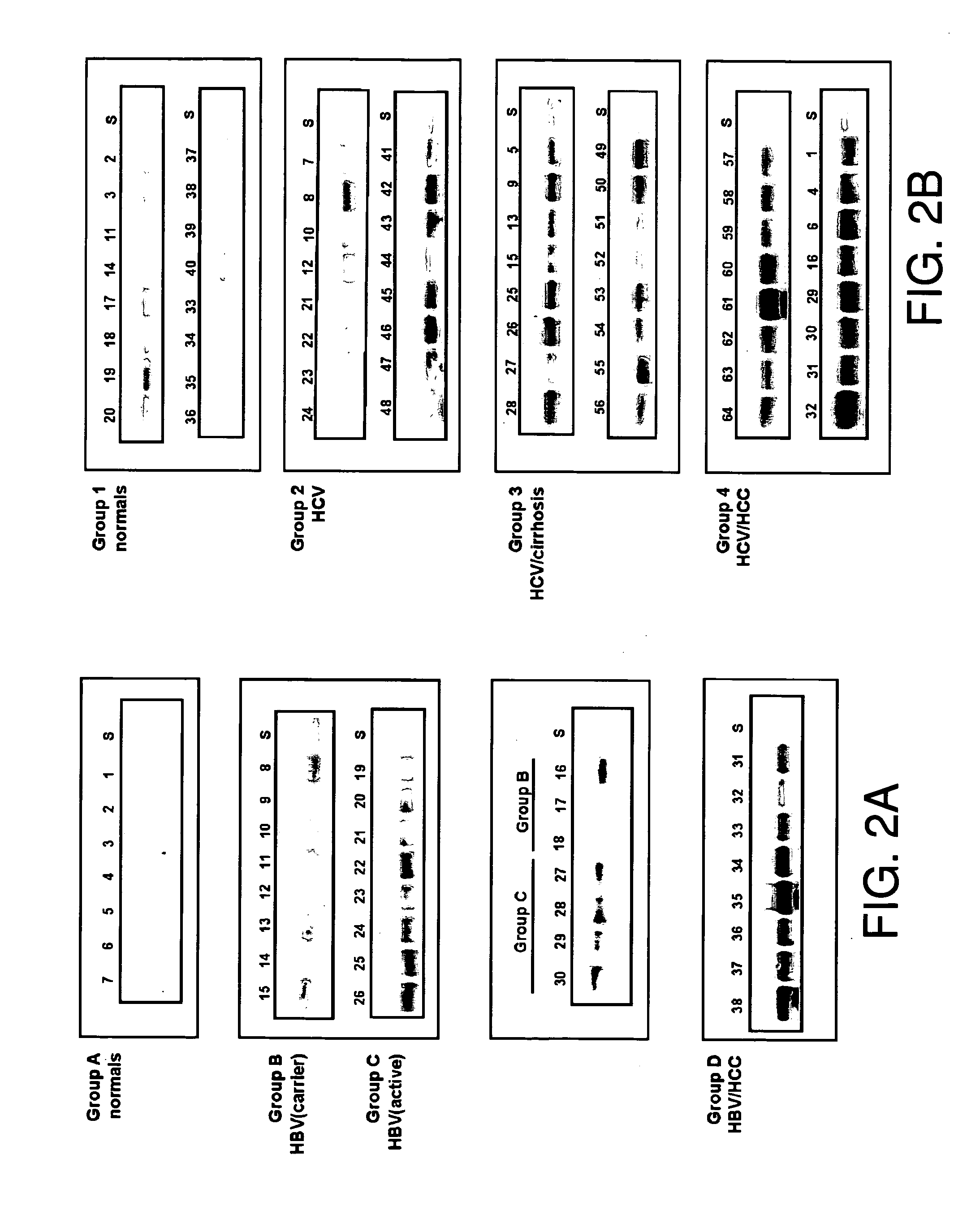 Diagnosis and monitoring of hepatocellular carcinoma