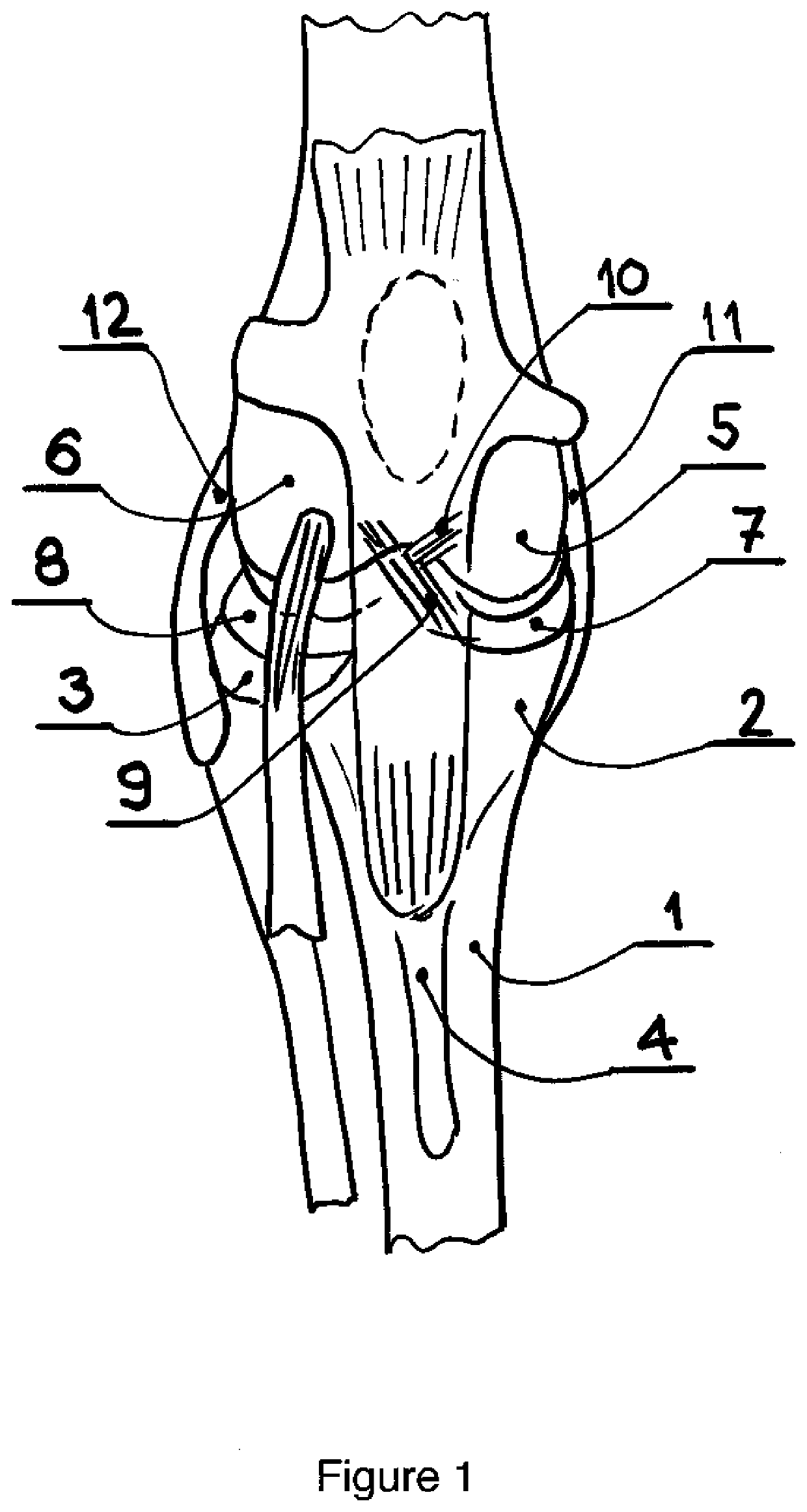 Tibia condyle resurfacing prosthesis