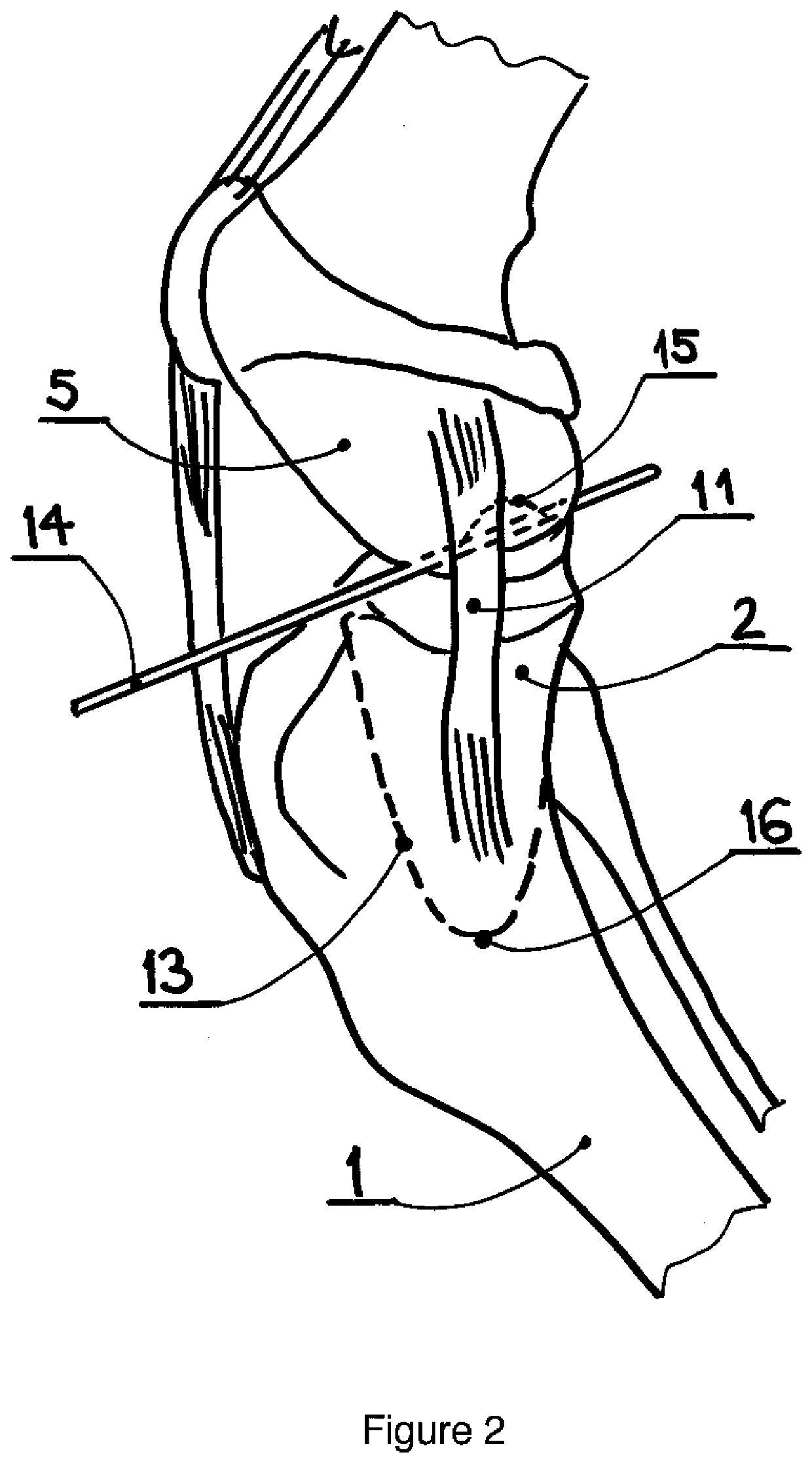 Tibia condyle resurfacing prosthesis