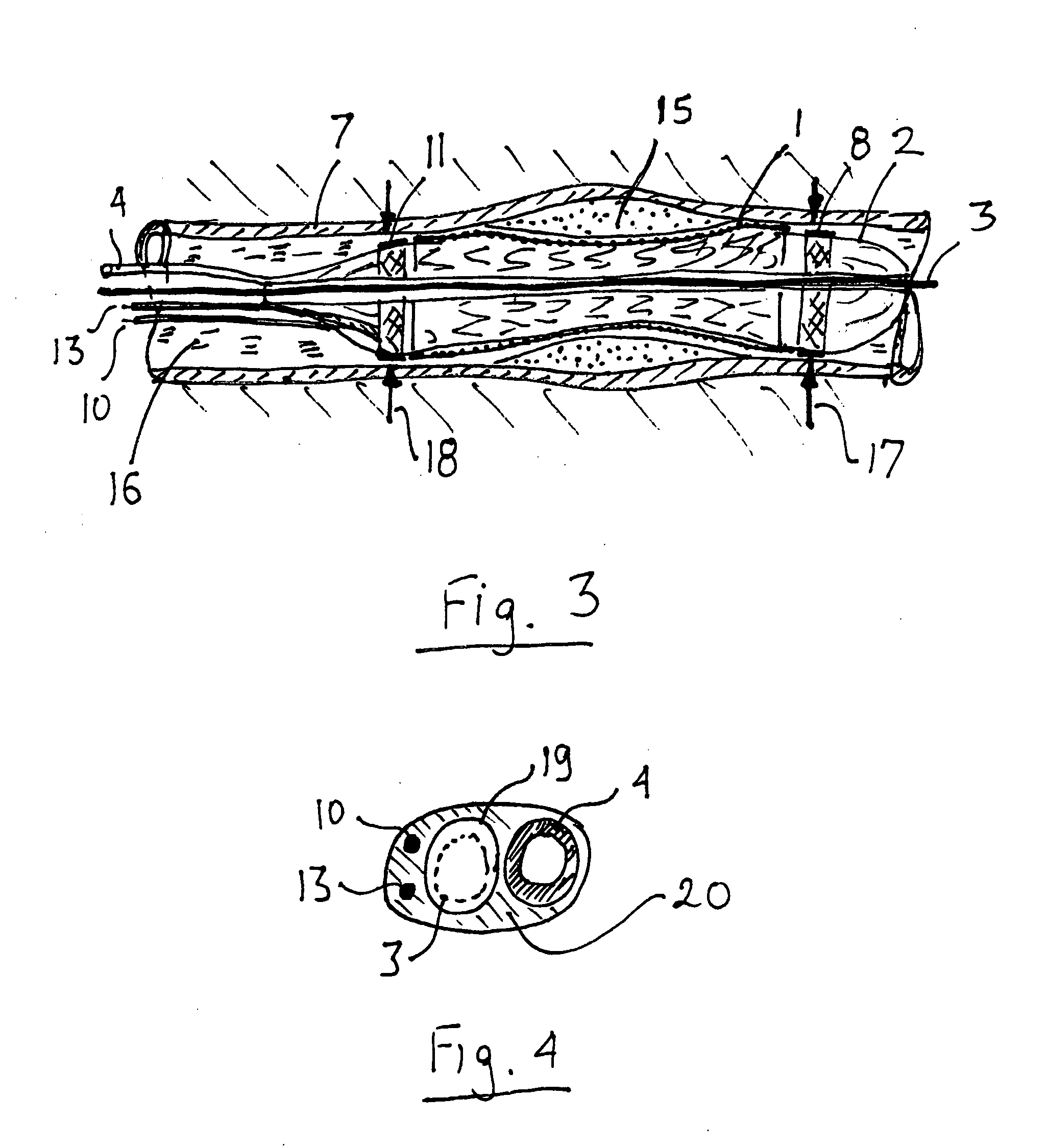 Lumen diameter and stent apposition sensing