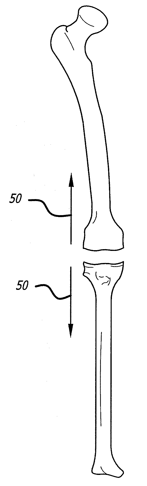 Extra-articular implantable mechanical energy absorbing systems and implantation method