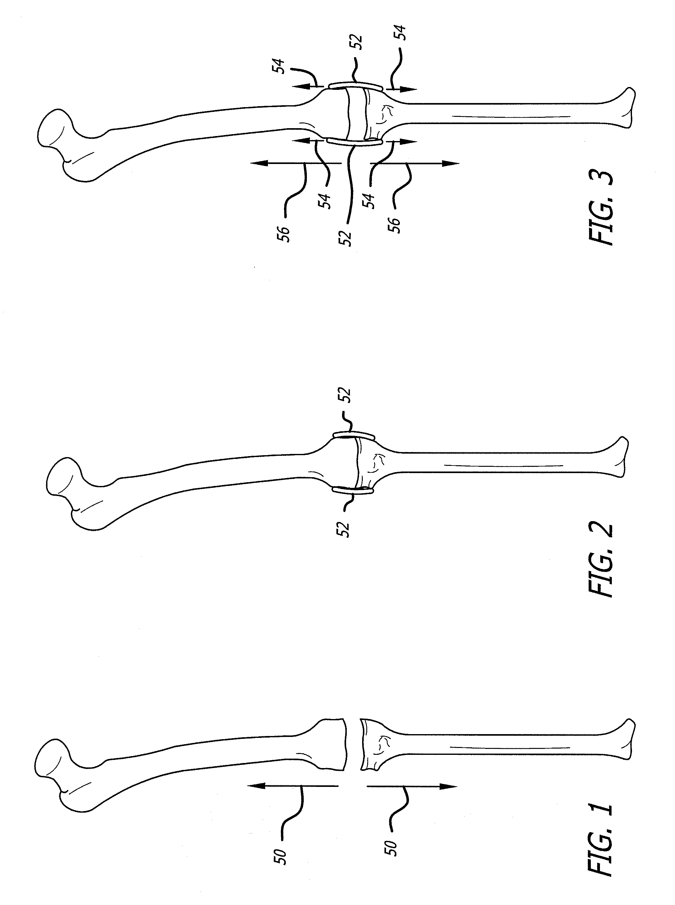 Extra-articular implantable mechanical energy absorbing systems and implantation method