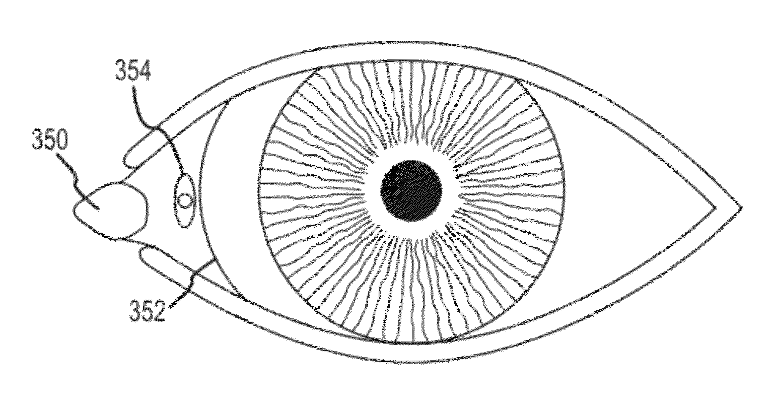 Implant device, tool, and methods relating to treatment of paranasal sinuses