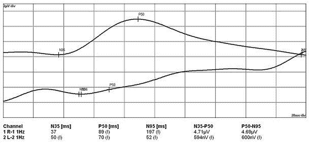 Method for recording pattern electroretinogram under complicated electromagnetic interference conditions