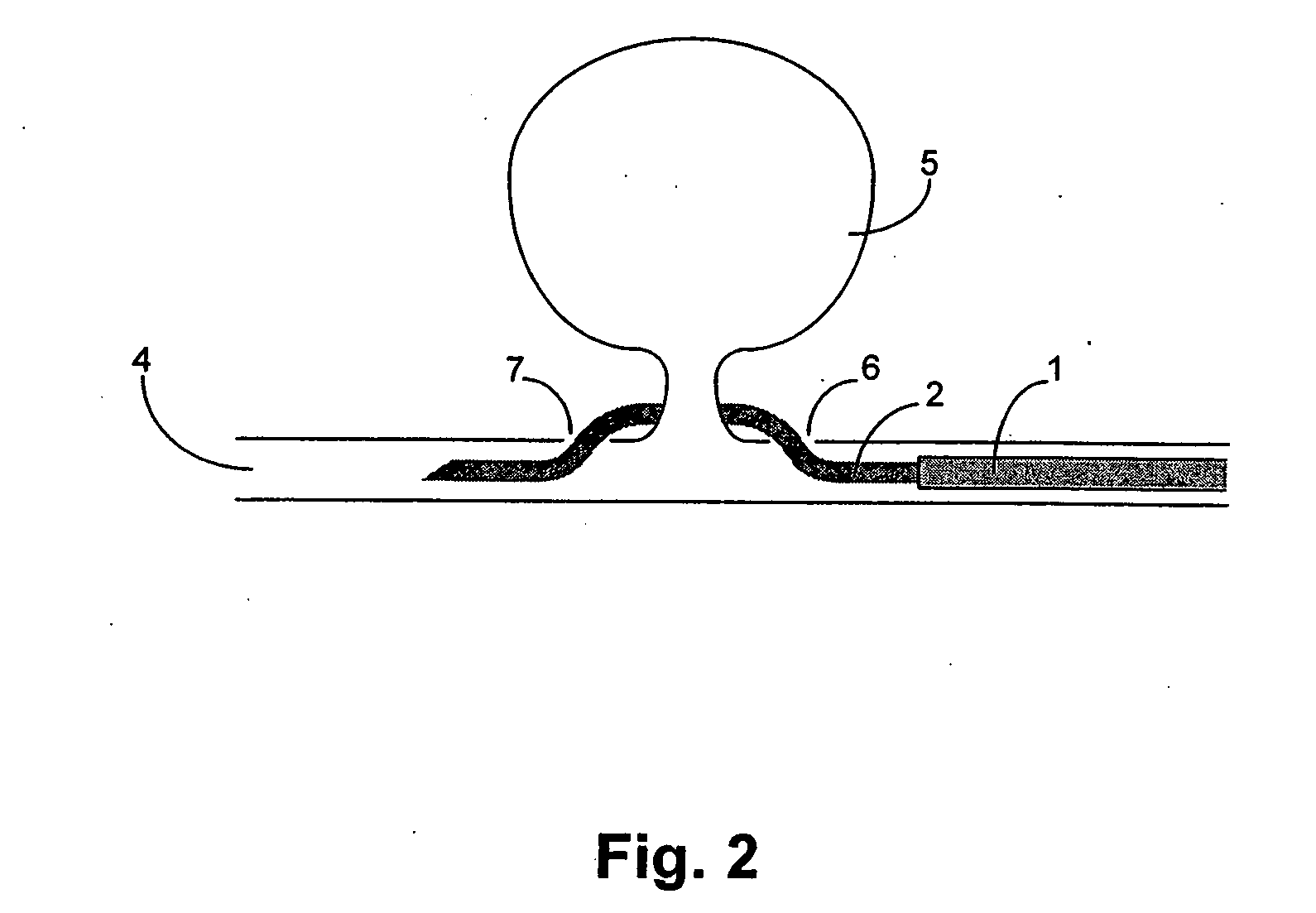 Device and methods for non-surgical clipping of aneurysms