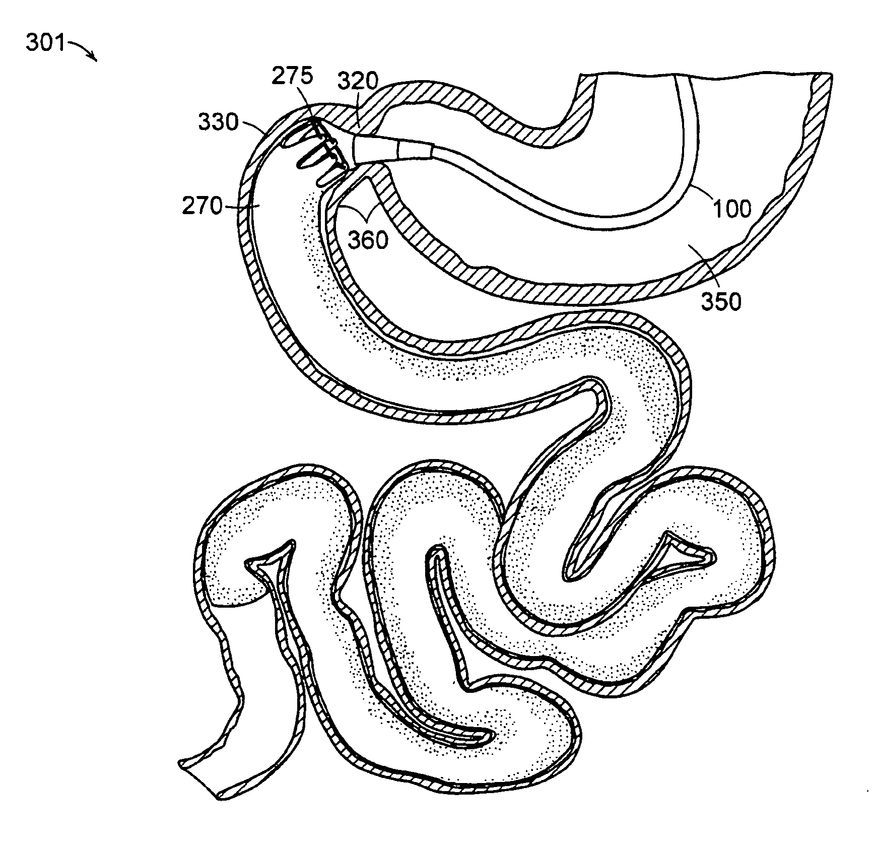 Gastrointestinal implant with drawstring