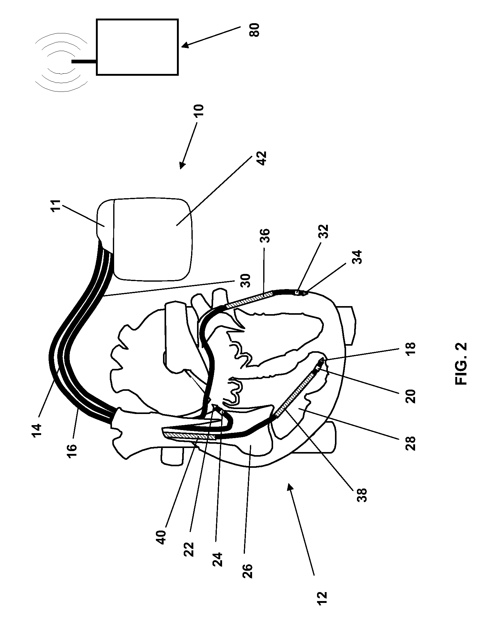 Implantable medical device