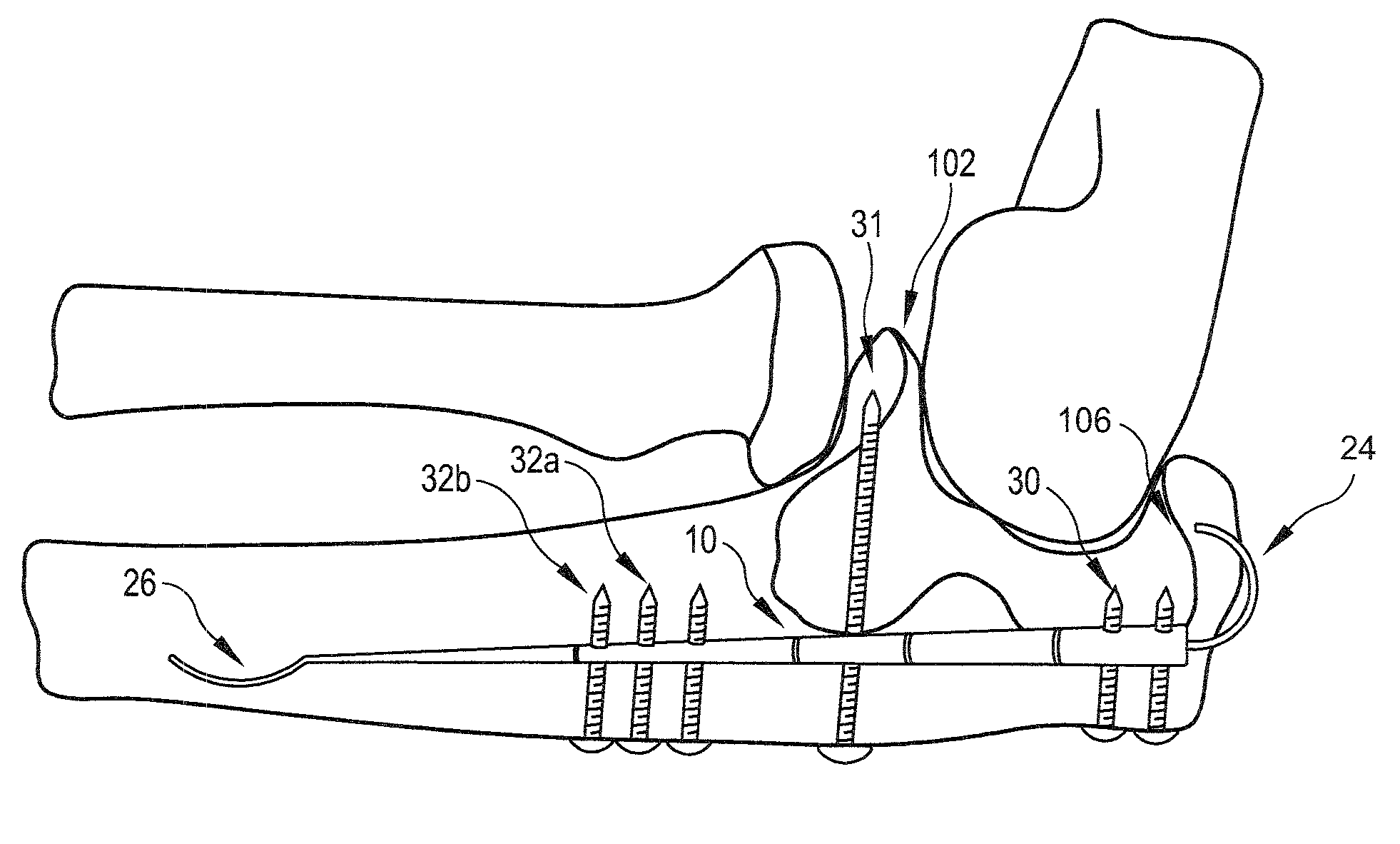 Fixation device for proximal elbow fractures and method of using same