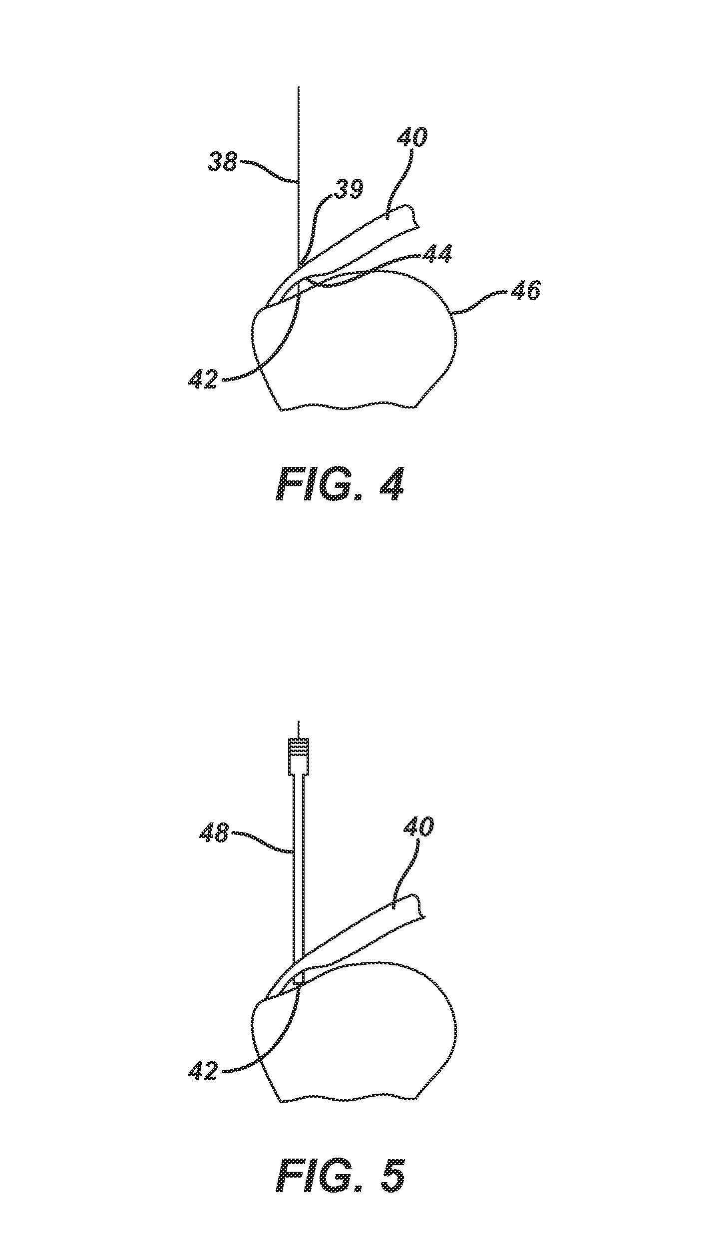 Partial thickness rotator cuff repair system and method