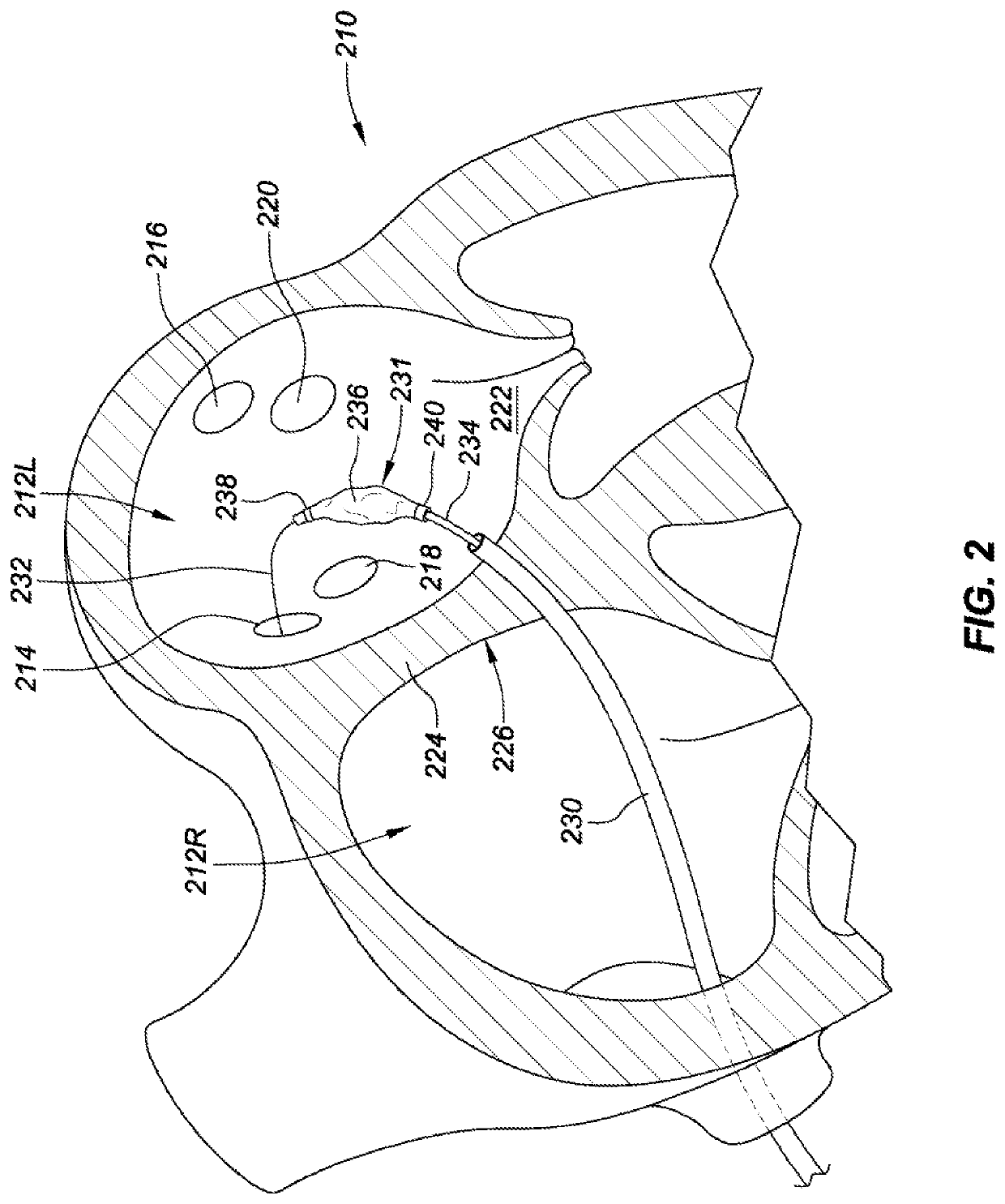 Pulmonary vein isolation balloon catheter