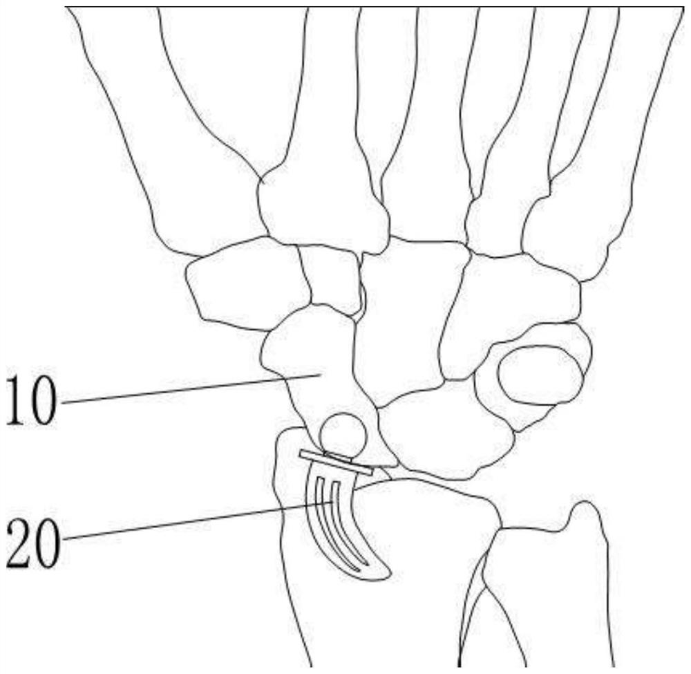 Adhesive ball socket joint type artificial navicular bone