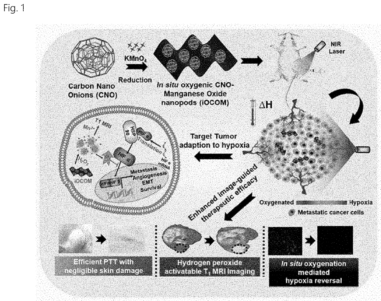 Tumor microenvironment-responsive nanacomplex and anticancer composition comprising same