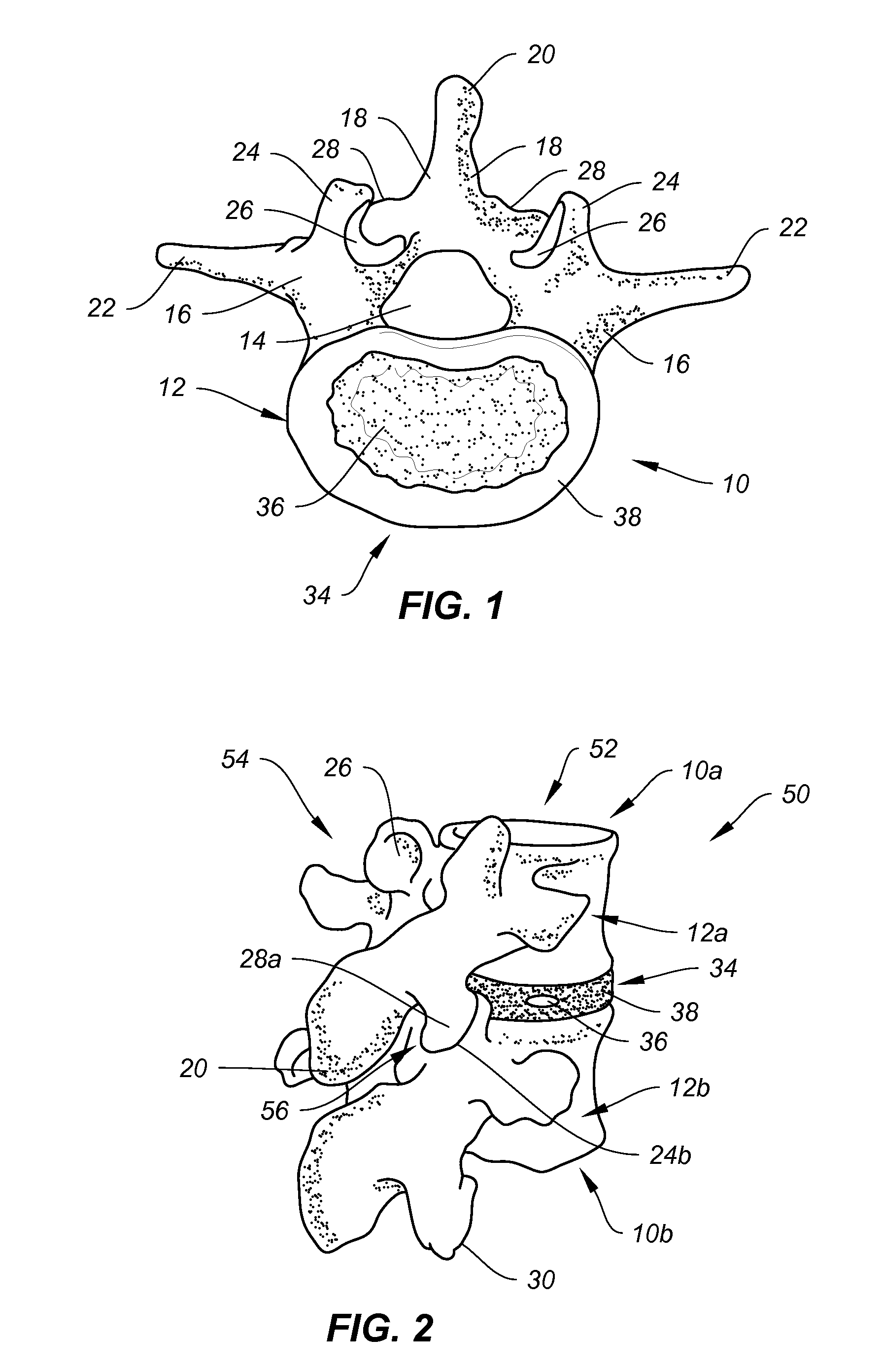 Systems and methods for stabilizing a functional spinal unit