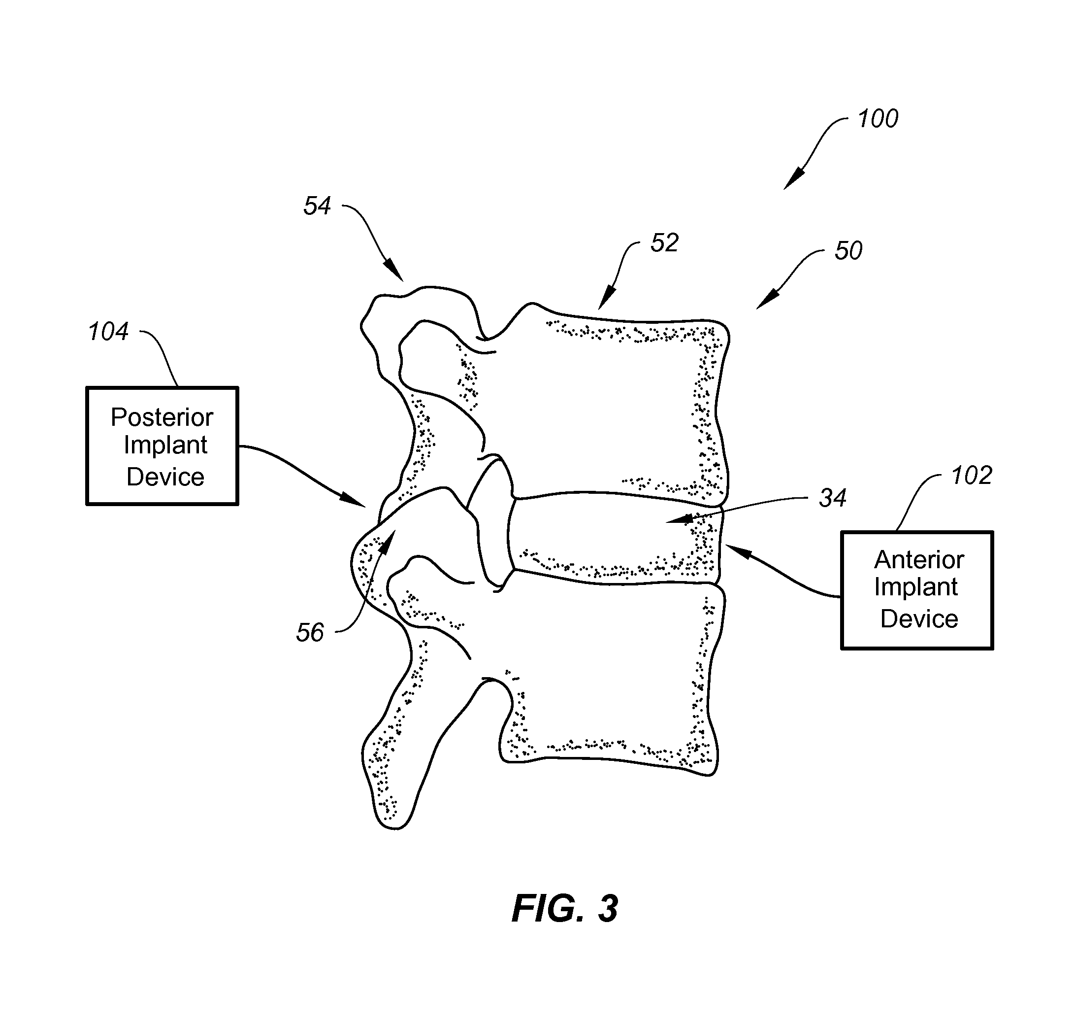 Systems and methods for stabilizing a functional spinal unit