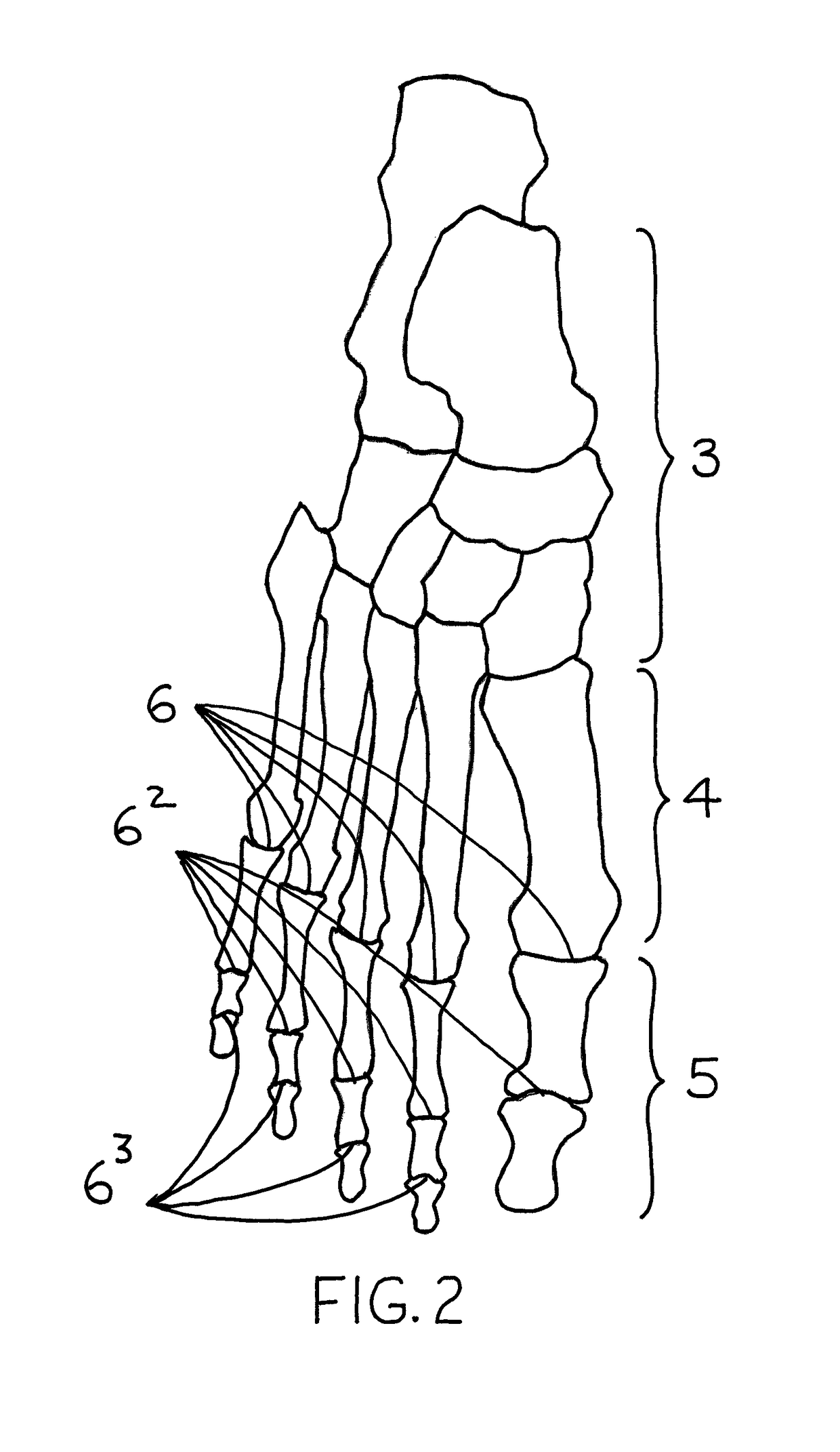 Hallux valgus brace