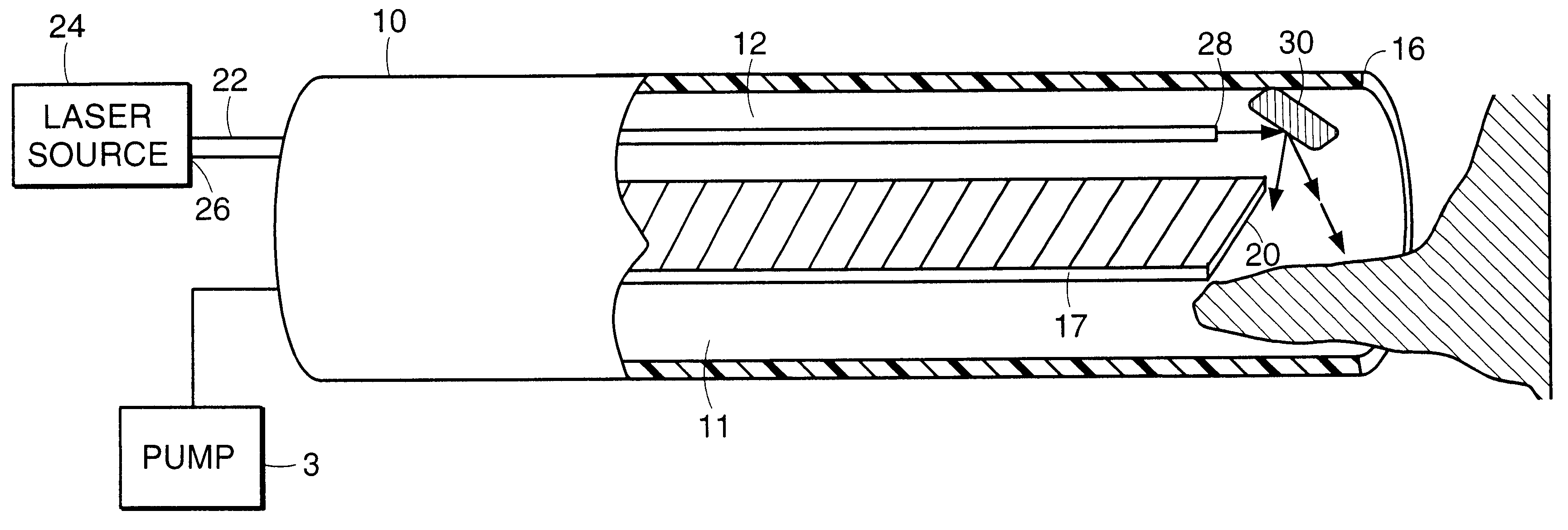 Laser lithotripsy device with suction