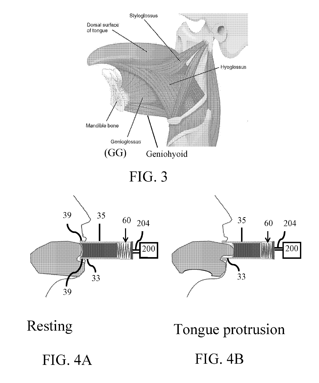 Threshold-load trainer apparatus for muscles of the tongue, throat and upper respiratory pathway and methods for treatment of obstructive sleep apnea and other disorders