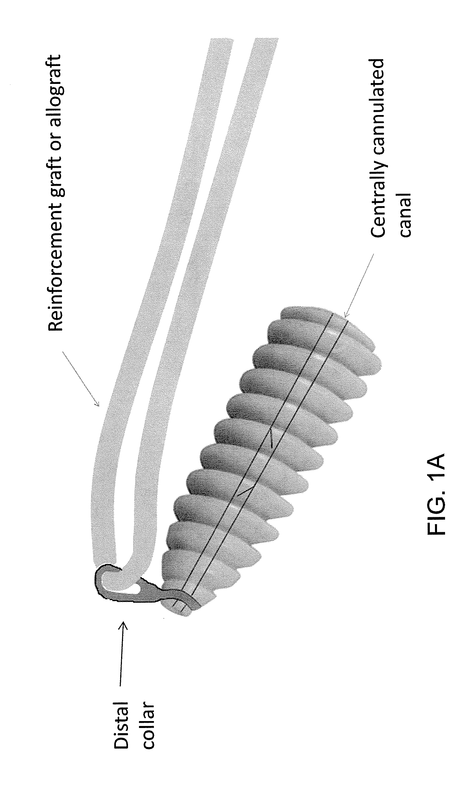 Implant and method for repair of the anterior cruciate ligament