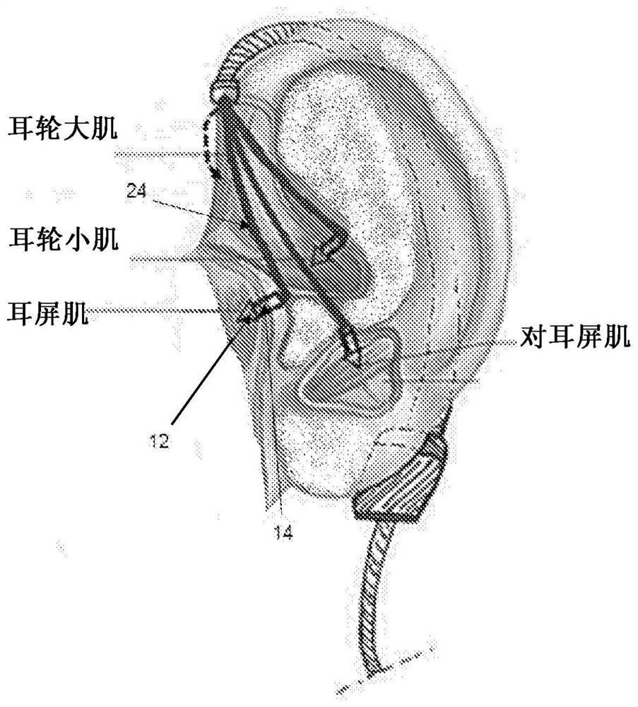 Effective electrical stimulation device for muscle location recognition and treatment response enhancement