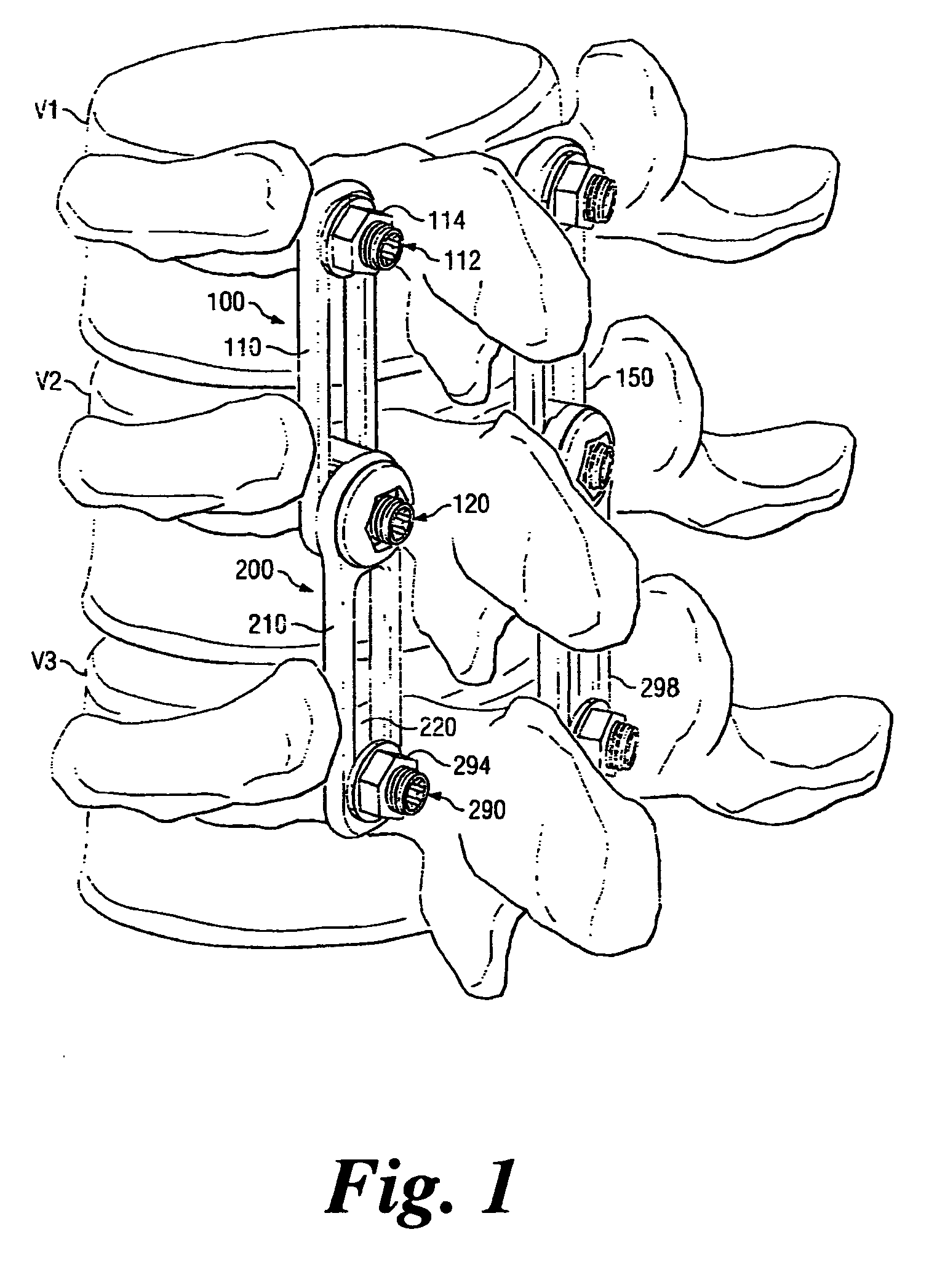 Revision Fixation Plate and Method of Use